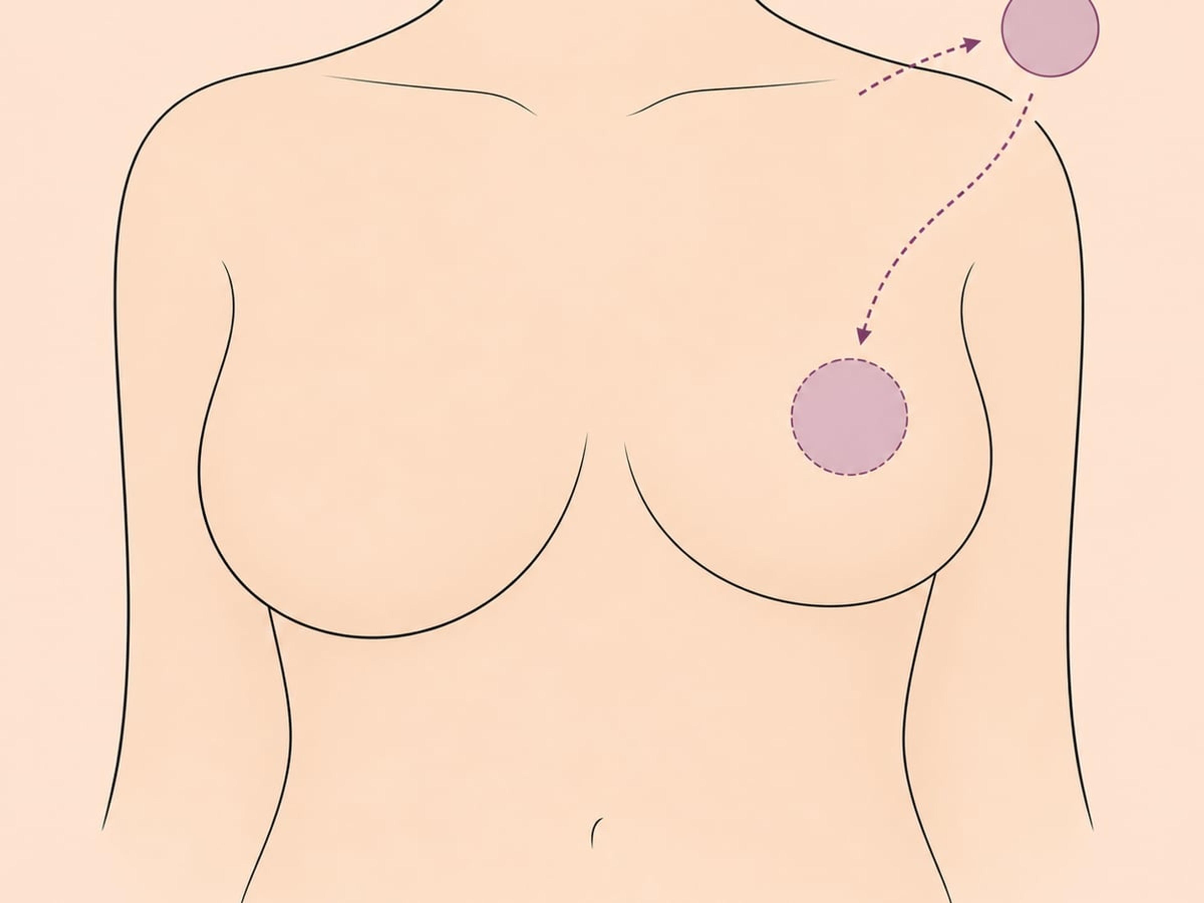 Freie Brustwarzentransplantation — illustration
