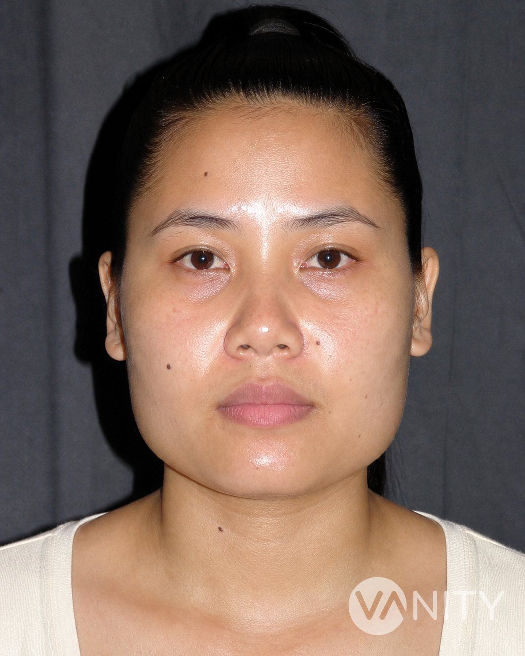 Before Jaw reduction — illustrative, not a real patient