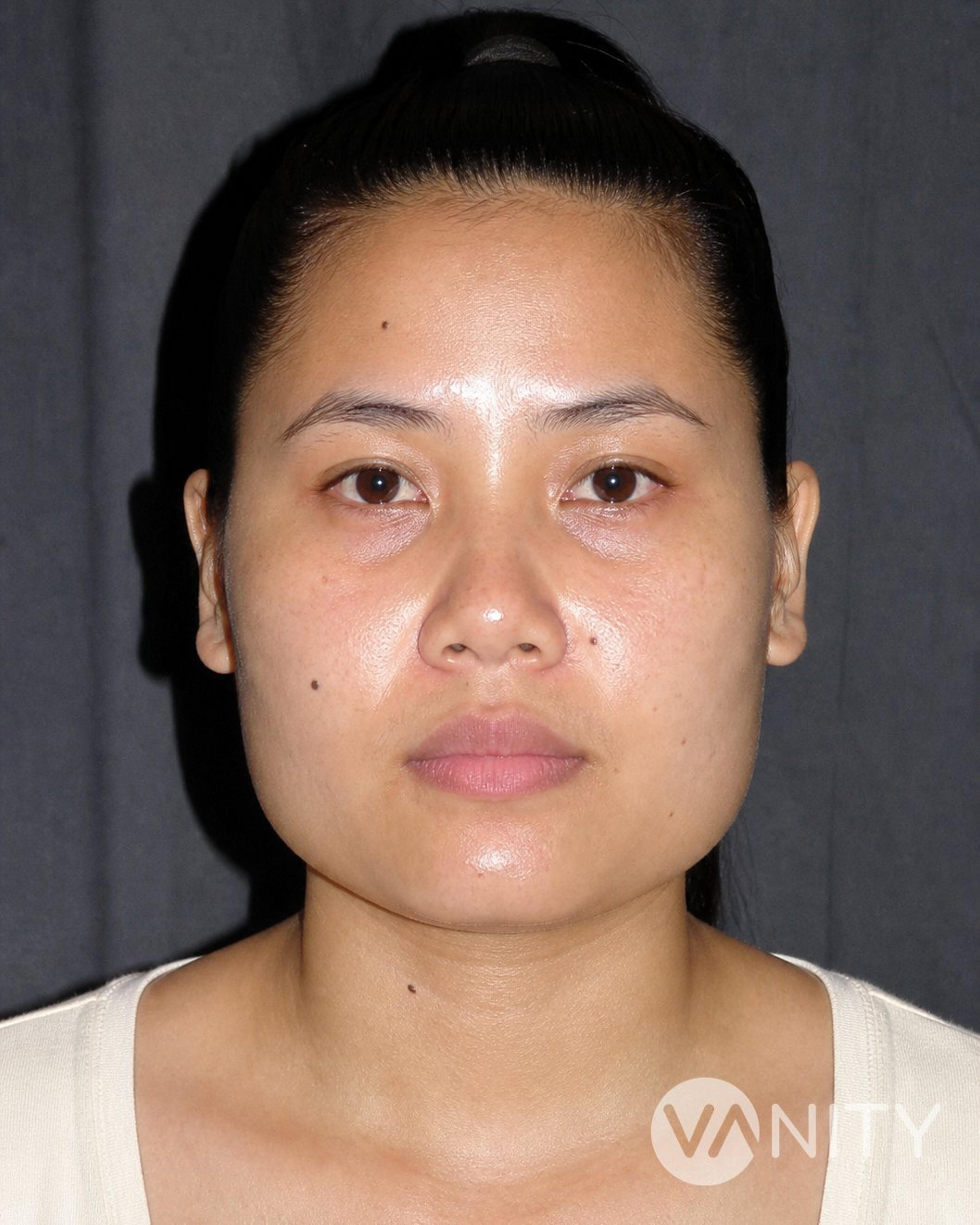 Before Jaw reduction — illustrative, not a real patient
