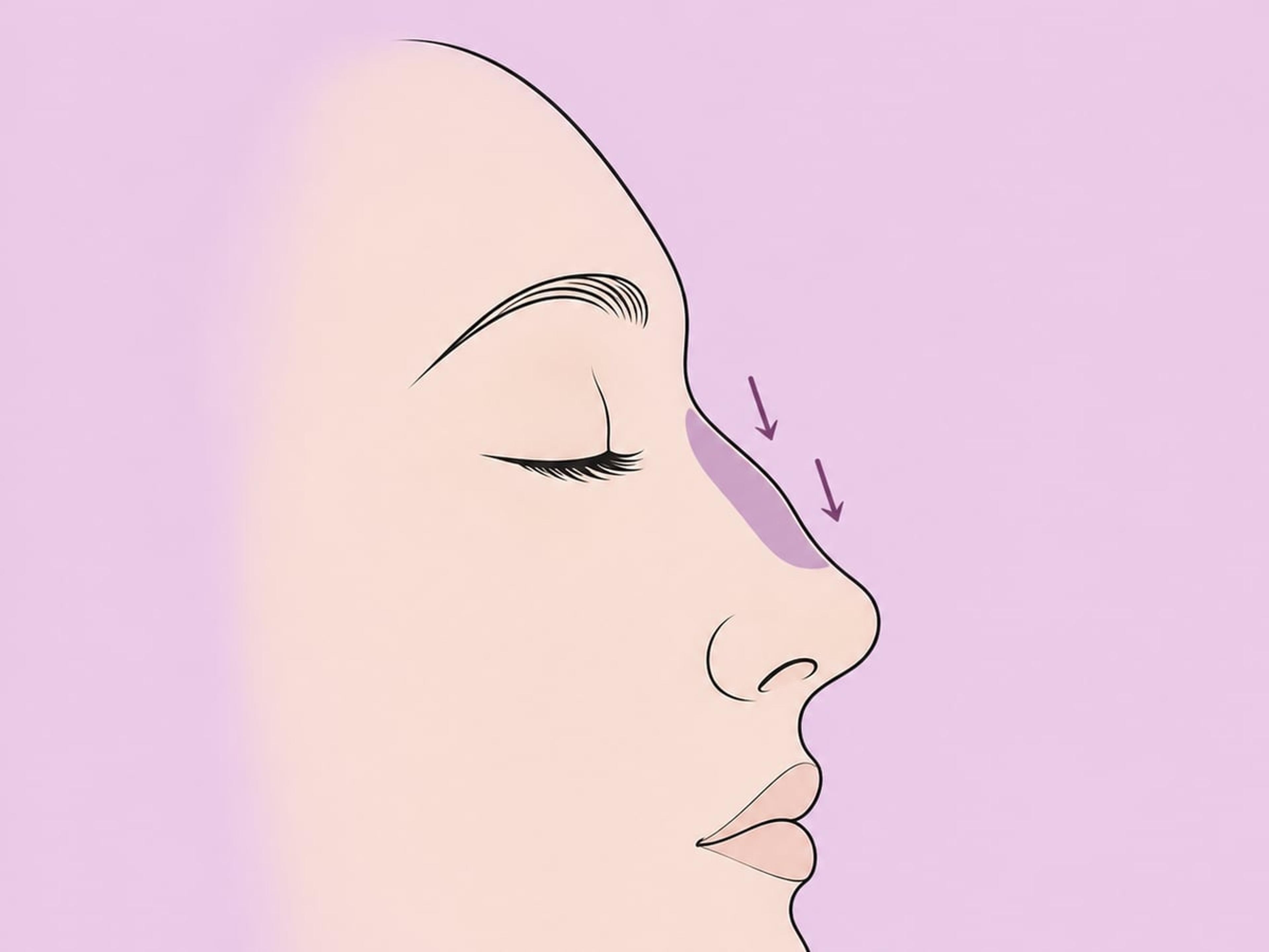 Erhaltende Rhinoplastik — illustration