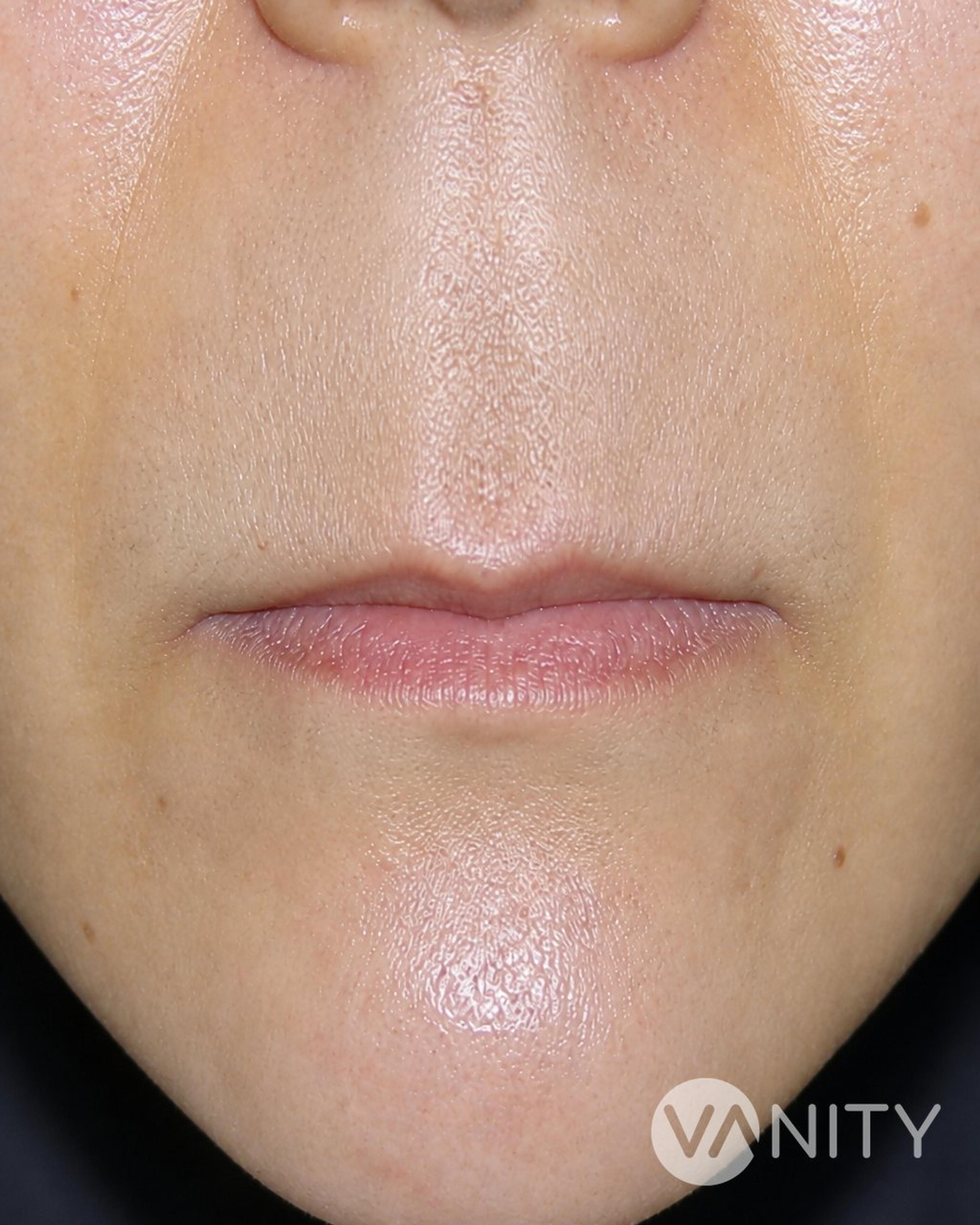 Before Lip lift — illustrative, not a real patient