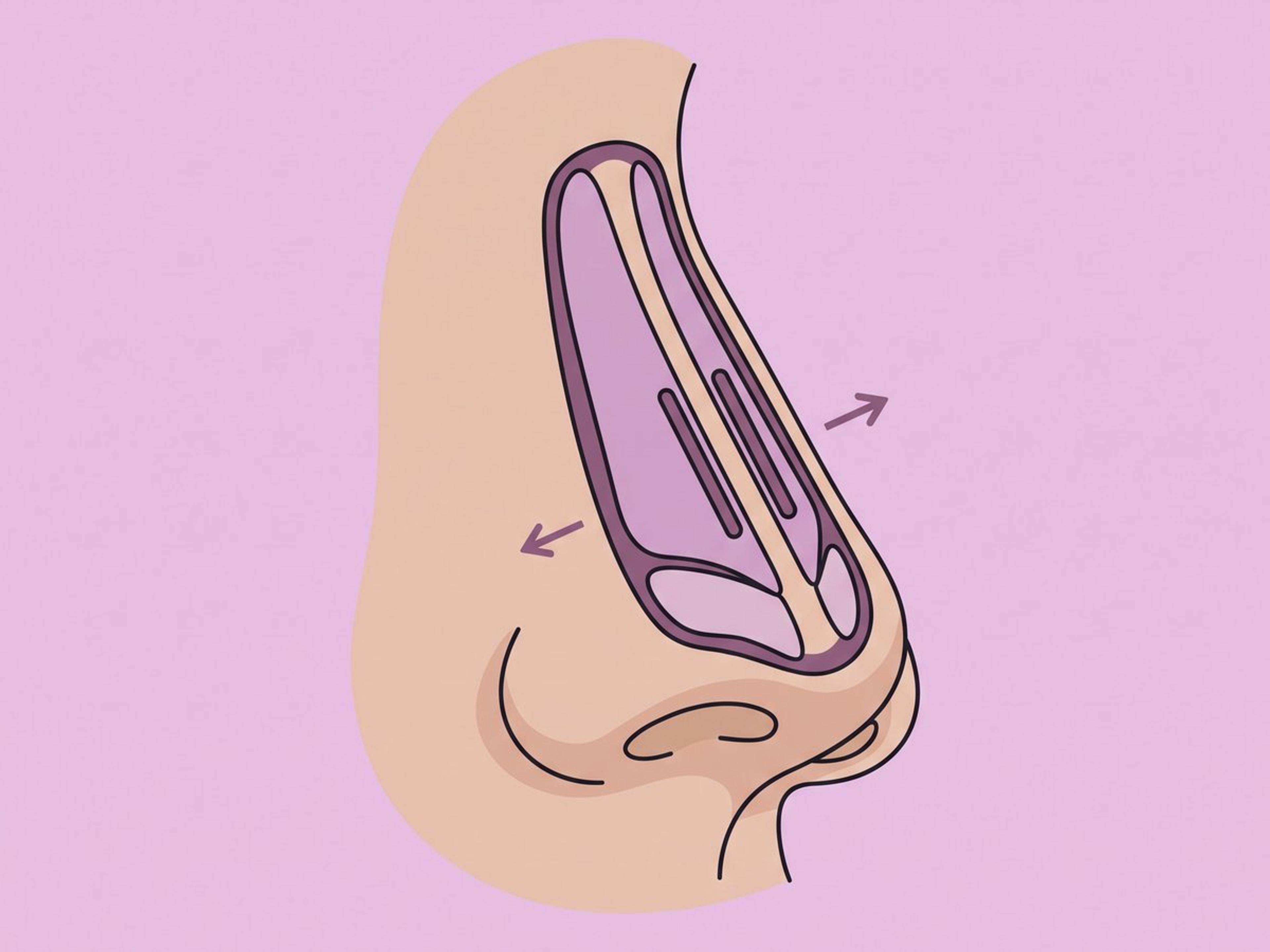 Spreader-Grafts und Rekonstruktion der Nasenklappe — illustration