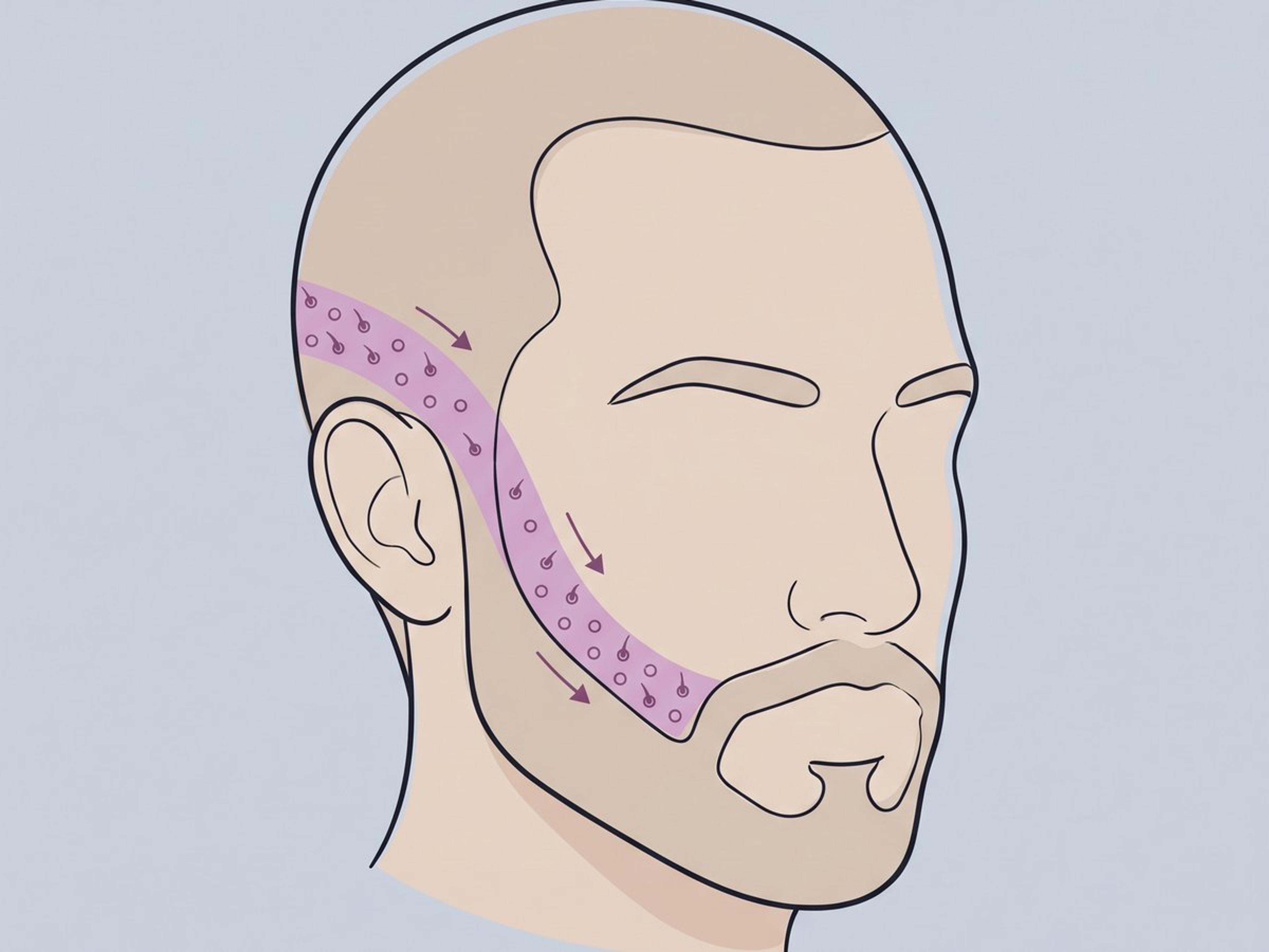 Follicular Unit Excision (FUE) — illustration