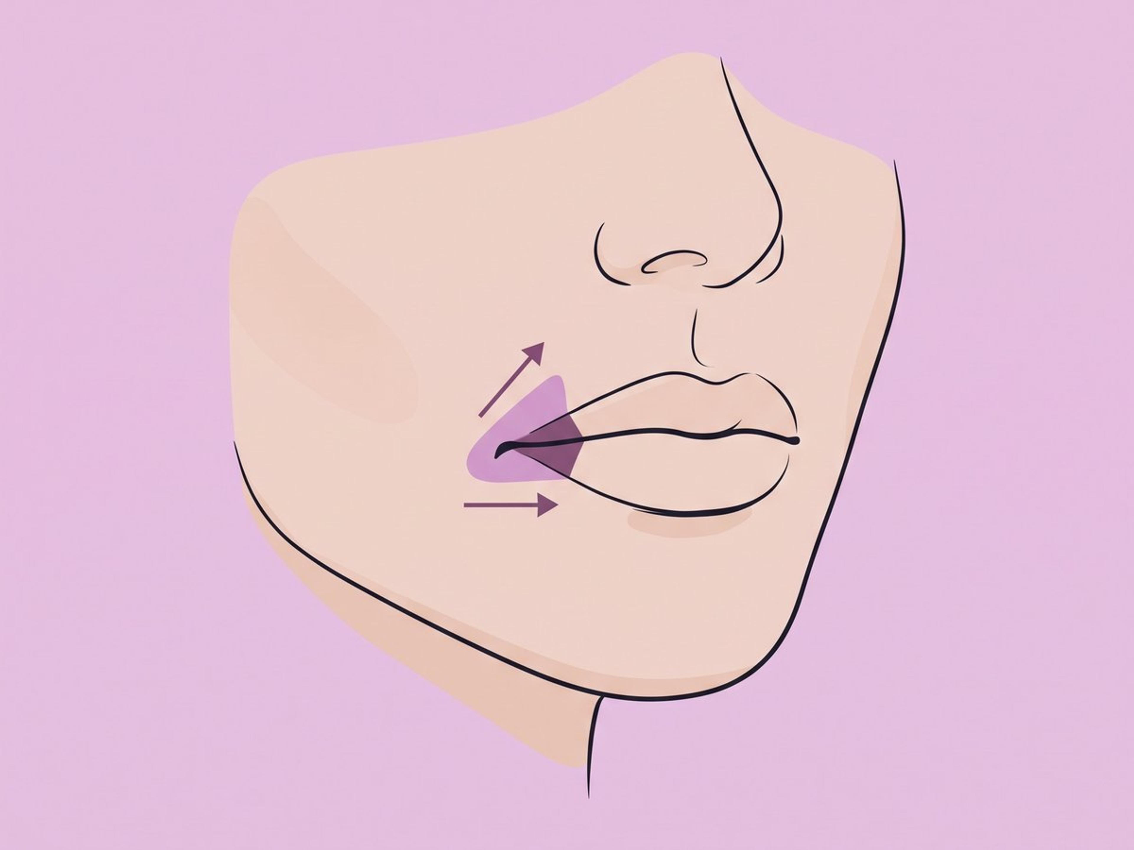 Mundwinkel-Lippenlifting — illustration