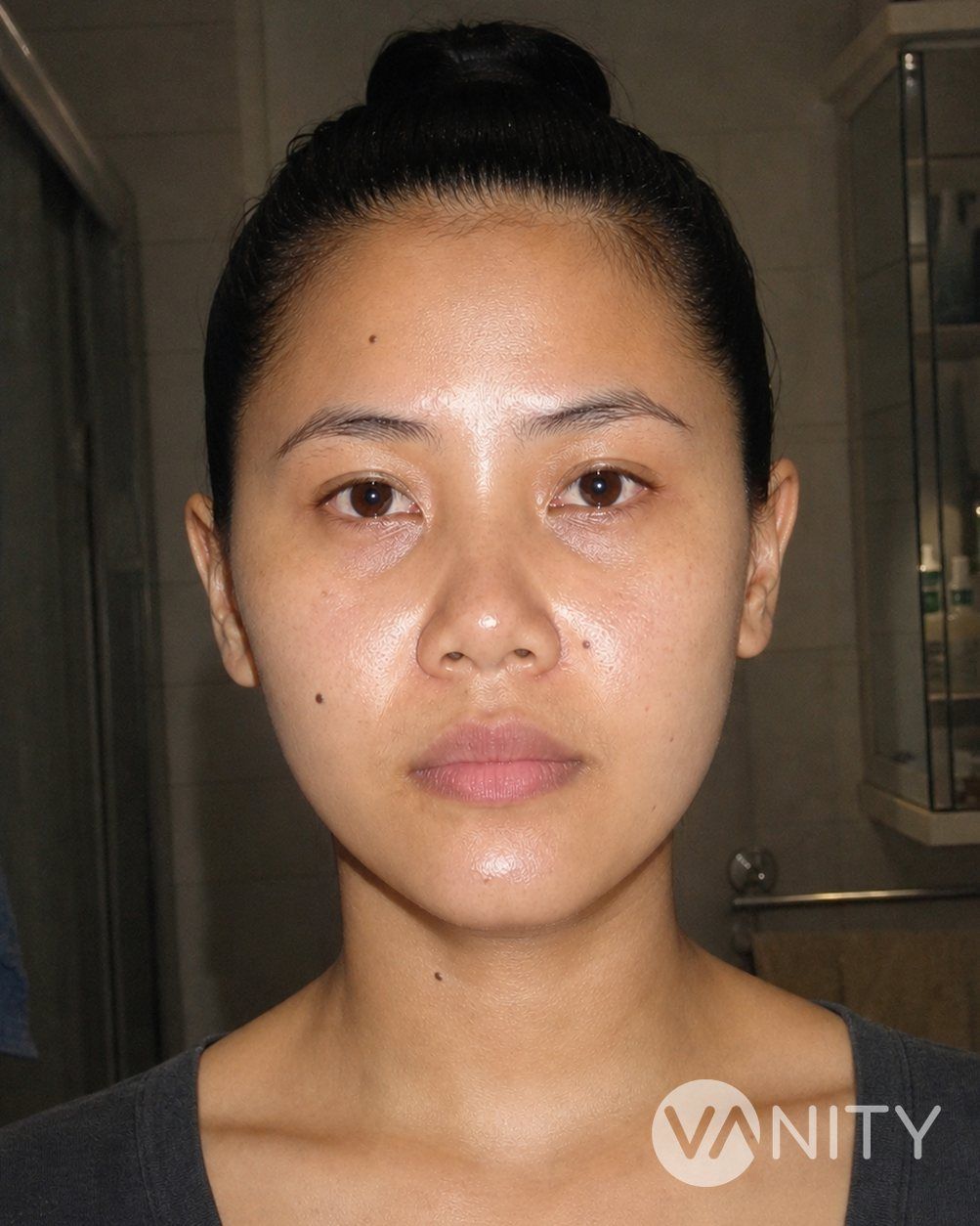 After Jaw reduction — illustrative, not a real patient