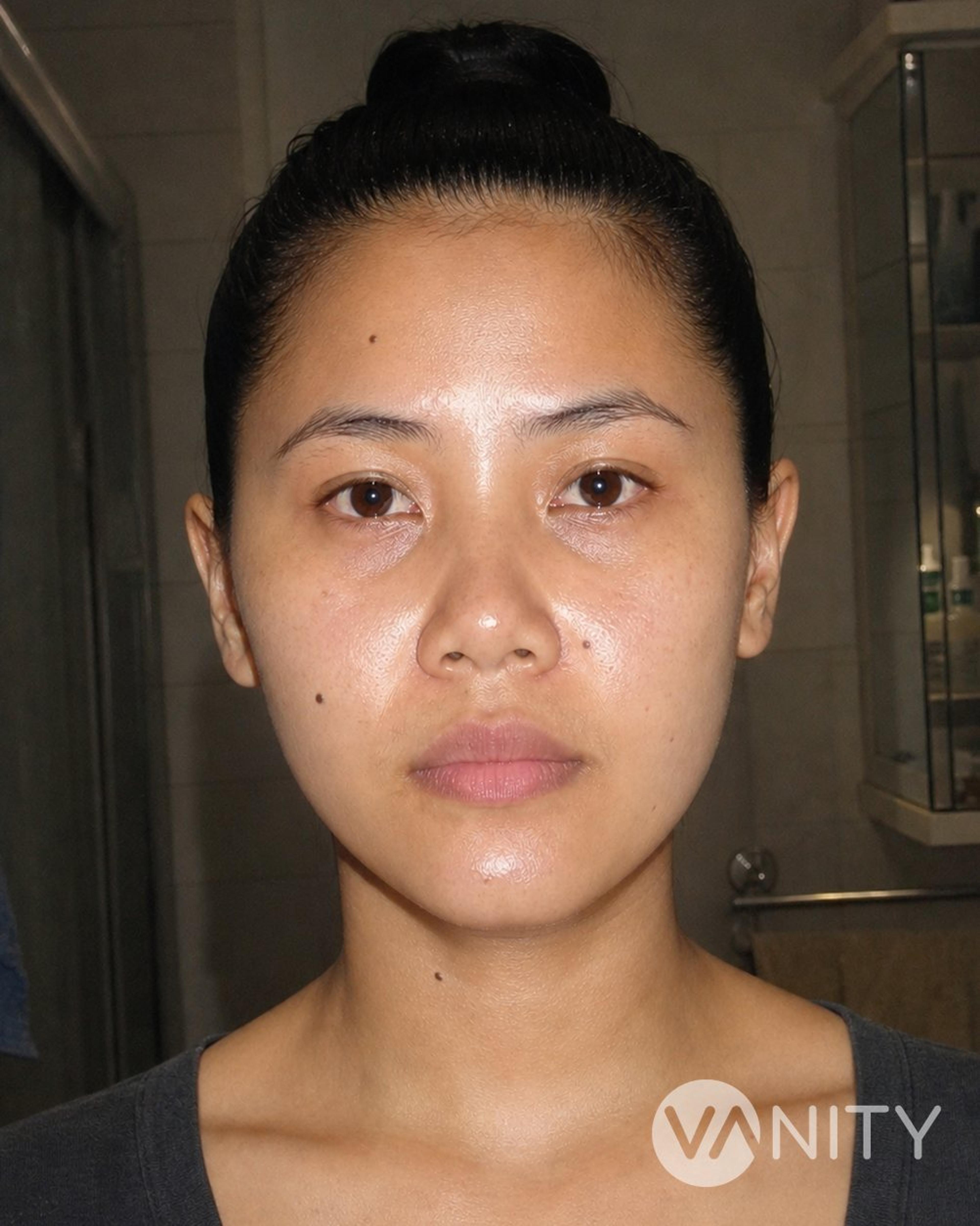 After Jaw reduction — illustrative, not a real patient