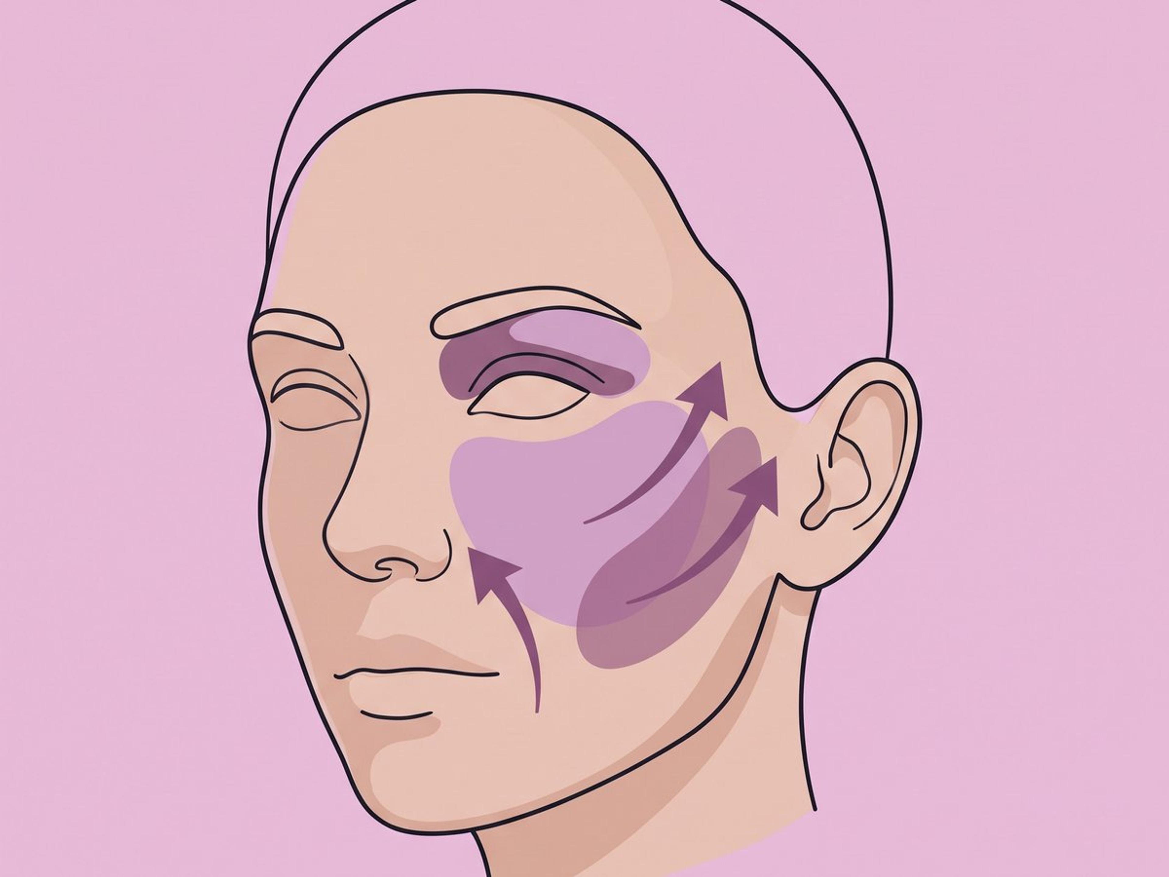 Lifting endoscópico de tercio medio facial por la sien — illustration