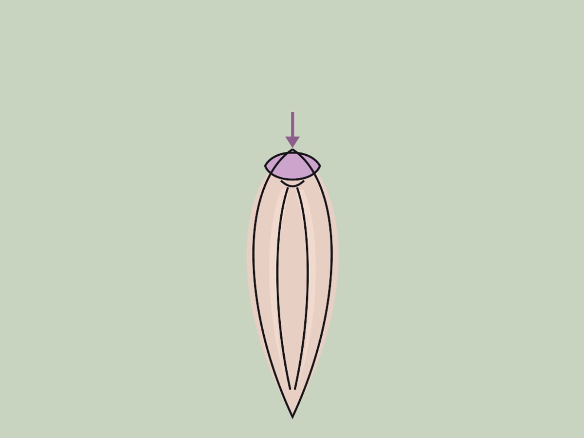 Klitorisvorhautreduktion — illustration