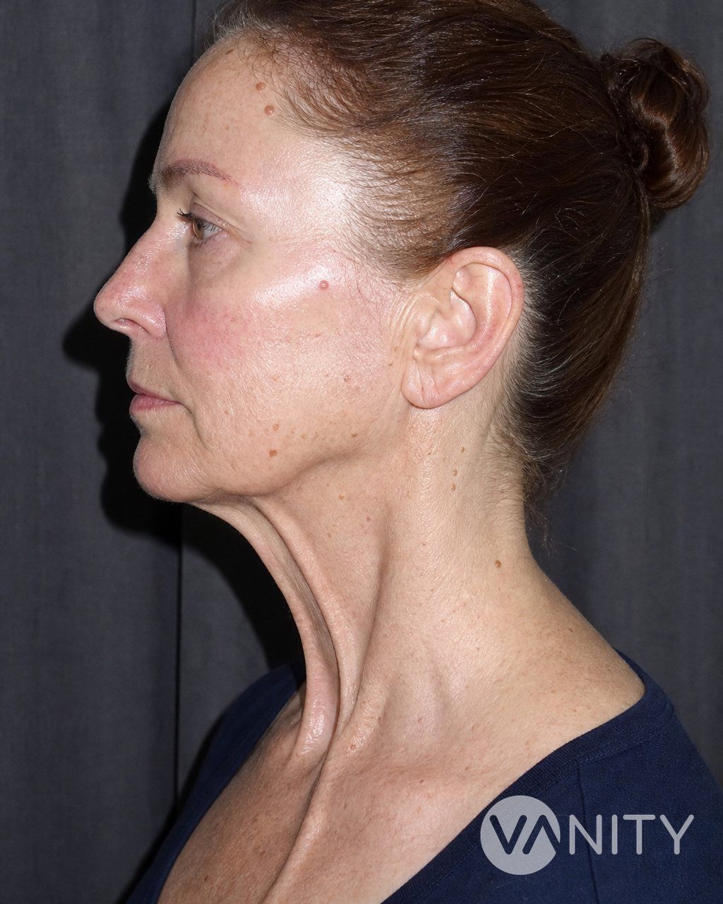 Before Platysmaplasty — illustrative, not a real patient