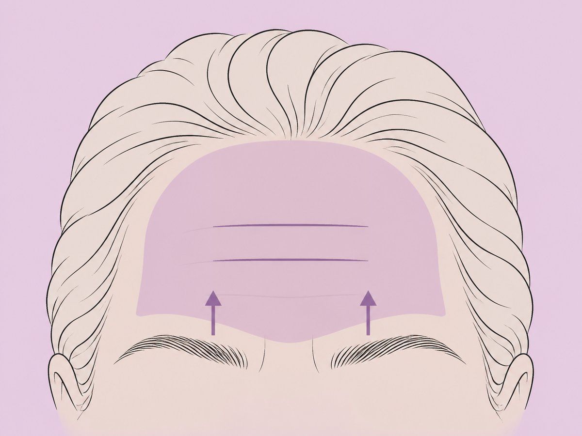 Mittlerer Stirnlift — illustration