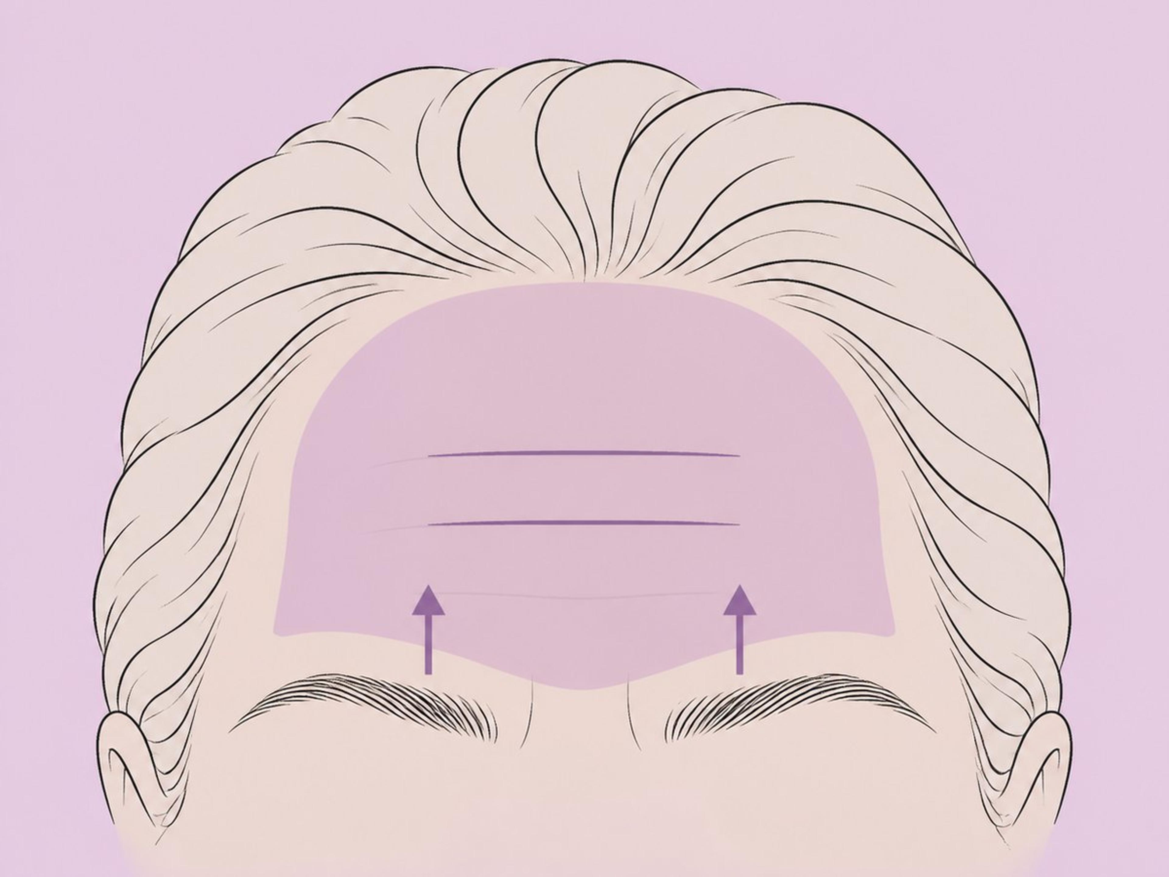 Mittlerer Stirnlift — illustration