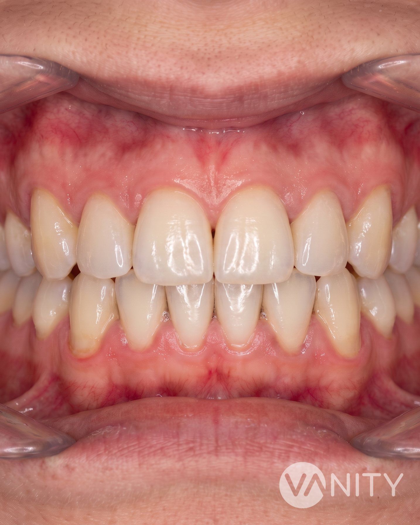 After Dental fillings — illustrative, not a real patient
