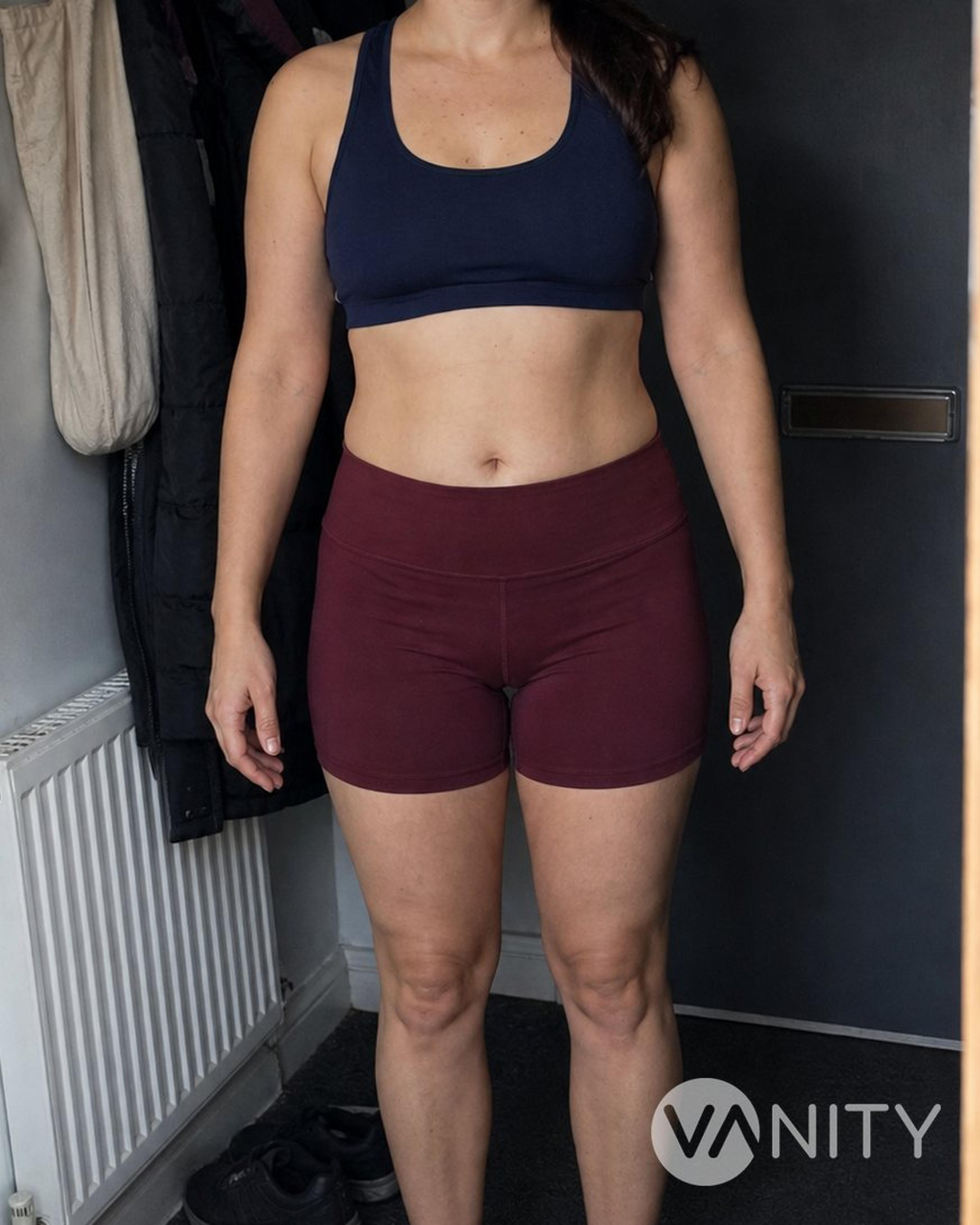 After Liposuction — illustrative, not a real patient