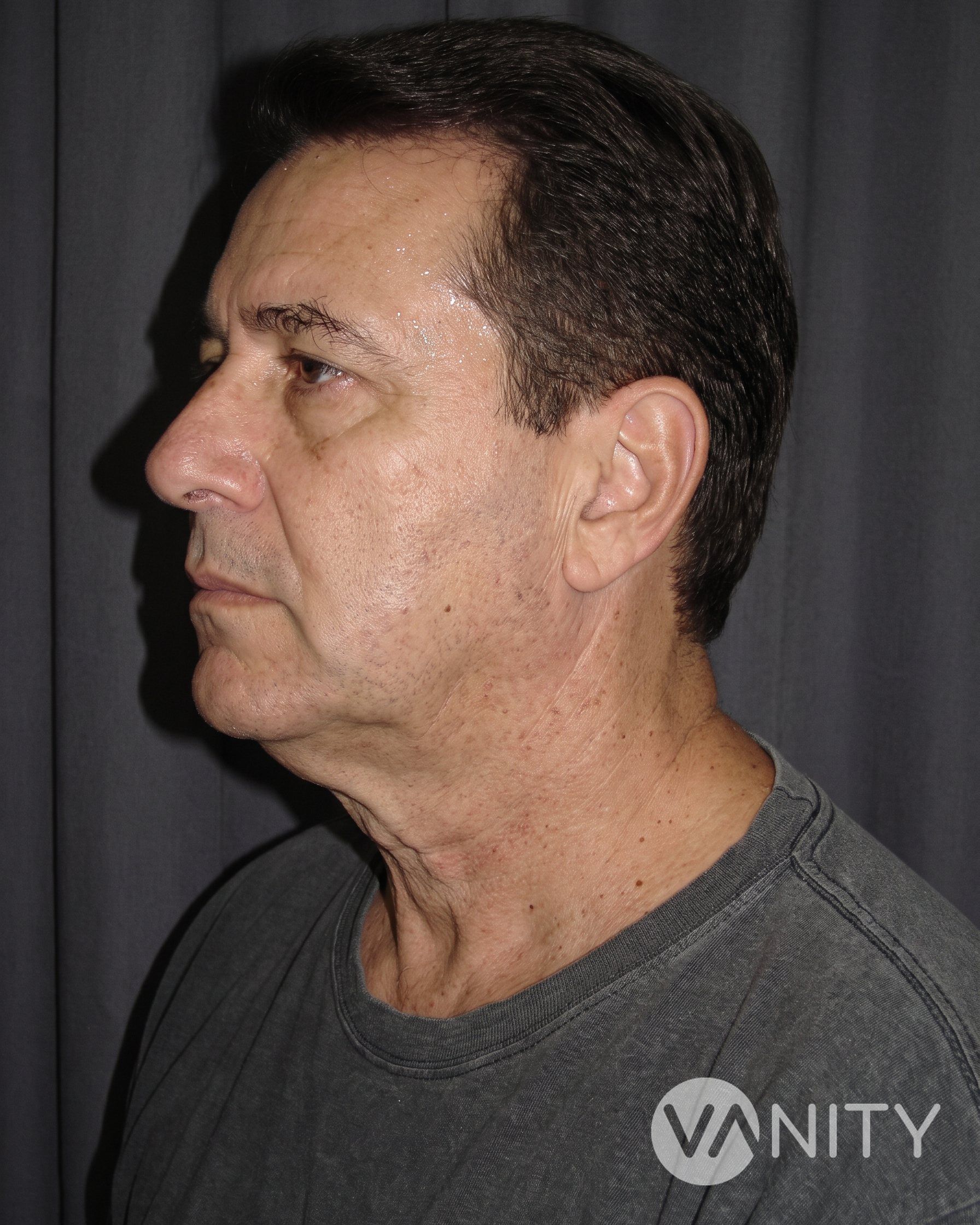 Before Neck lift — illustrative, not a real patient
