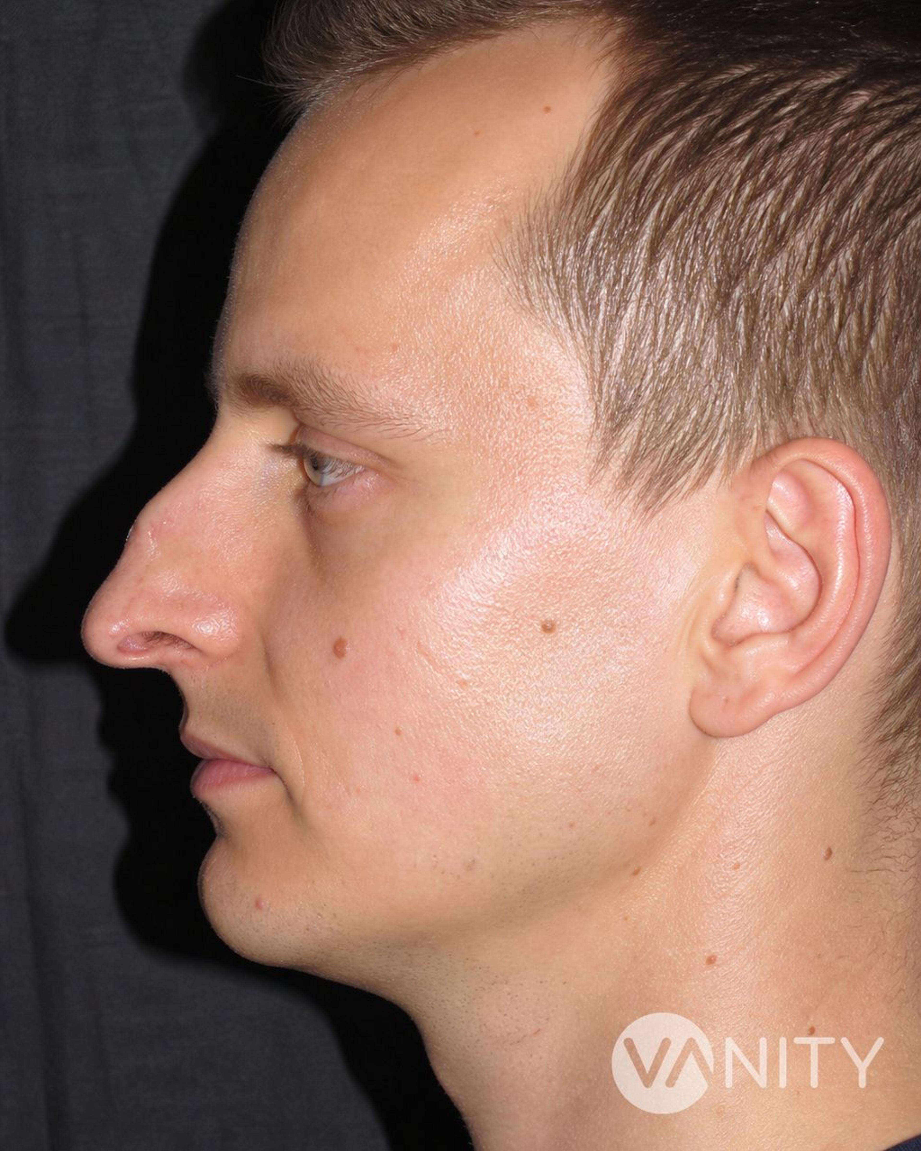 Before Secondary rhinoplasty — illustrative, not a real patient
