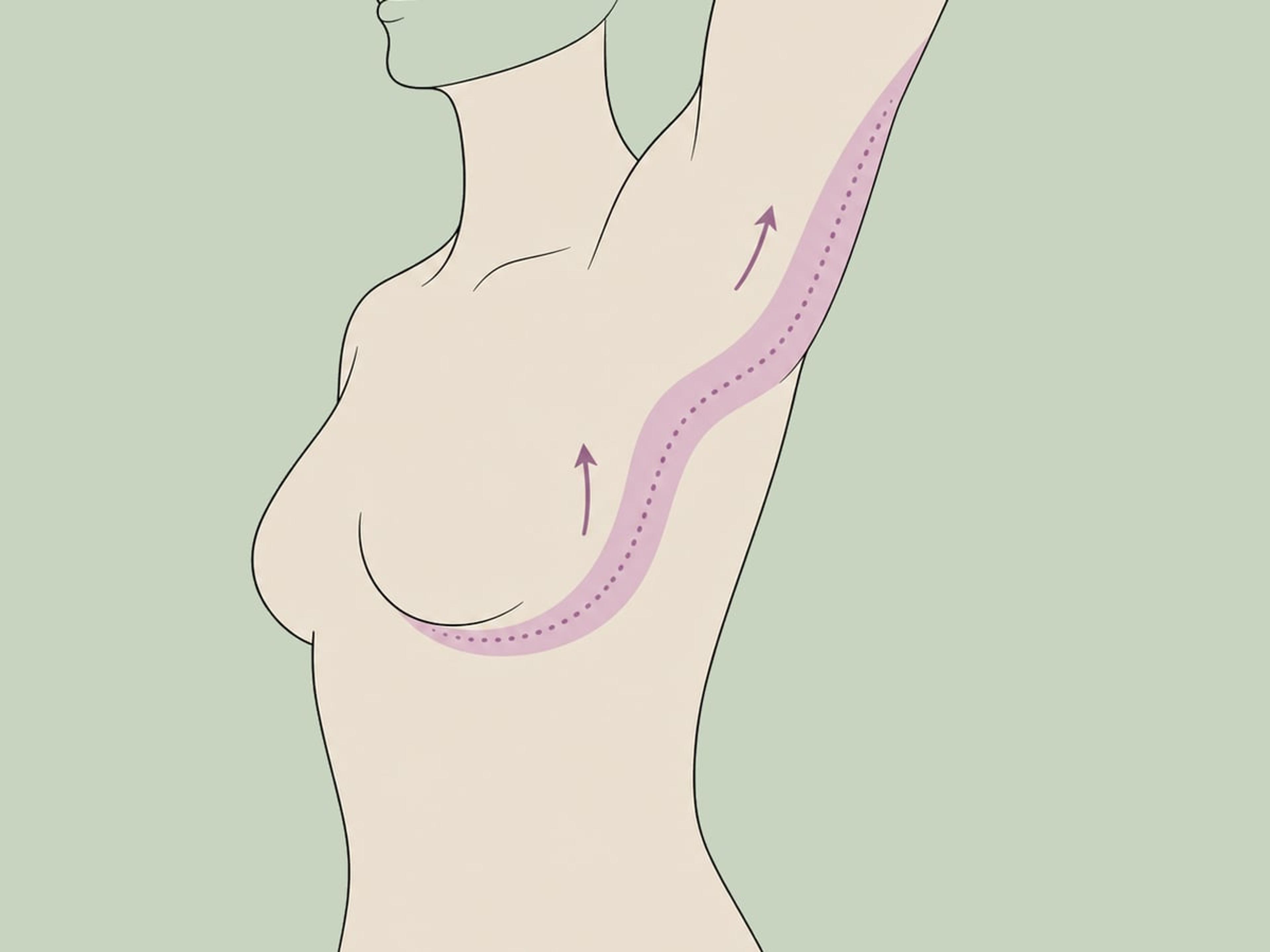 Erweiterte Brachioplastik — illustration