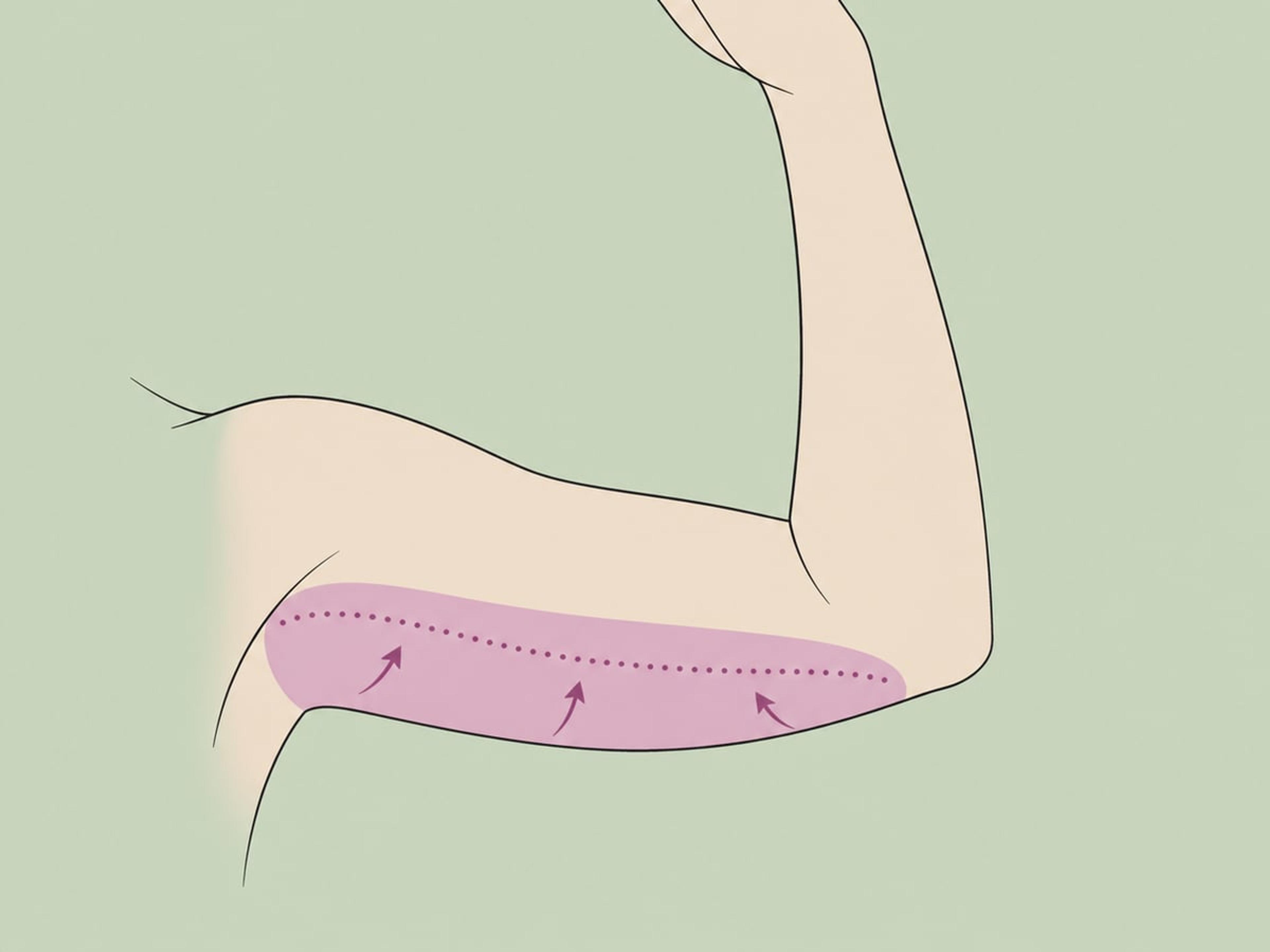 Standard-Brachioplastik — illustration