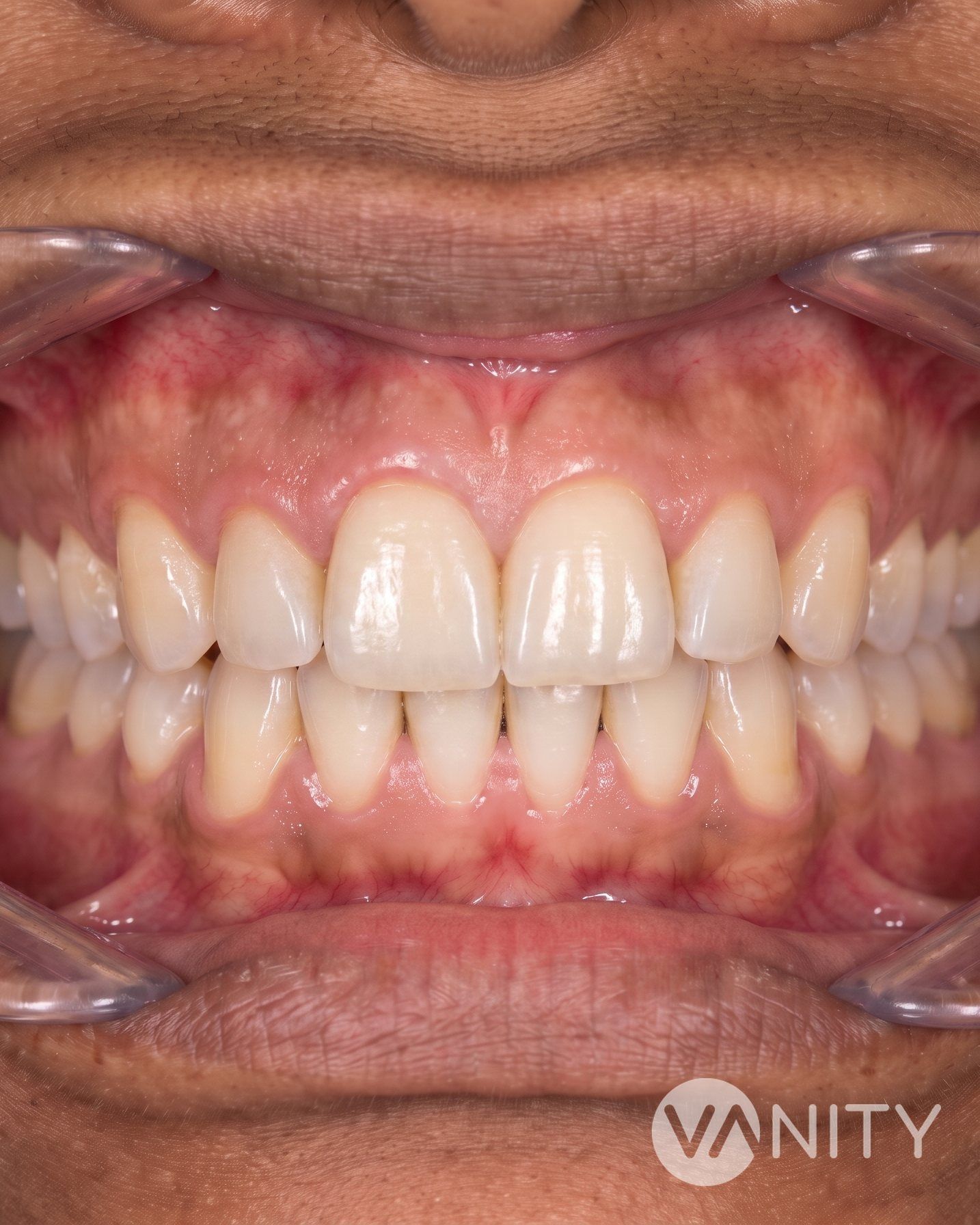 After Dental crowns — illustrative, not a real patient