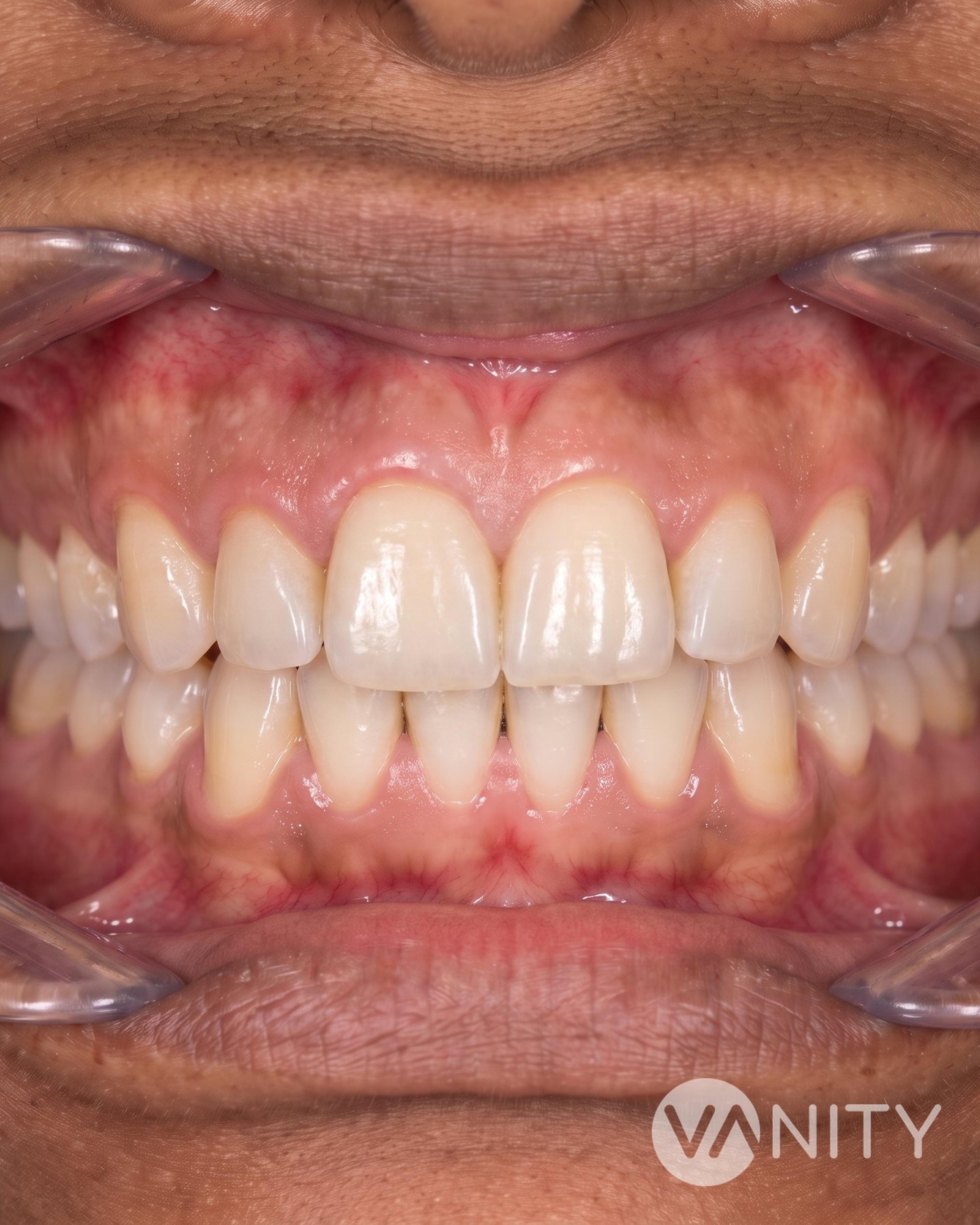 After Dental crowns — illustrative, not a real patient