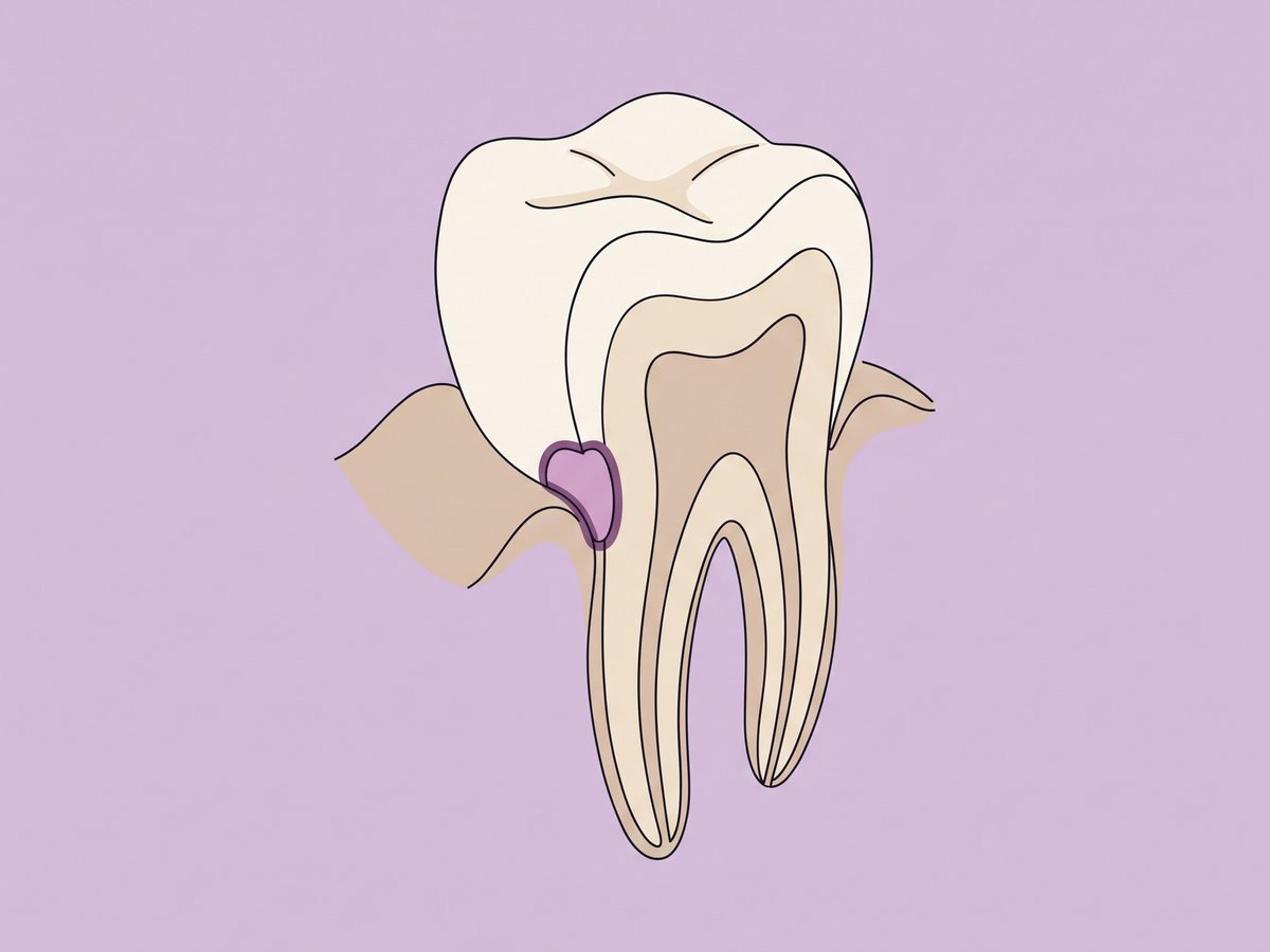 غلاس آيونومر وغلاس آيونومر المعدل بالراتنج — illustration