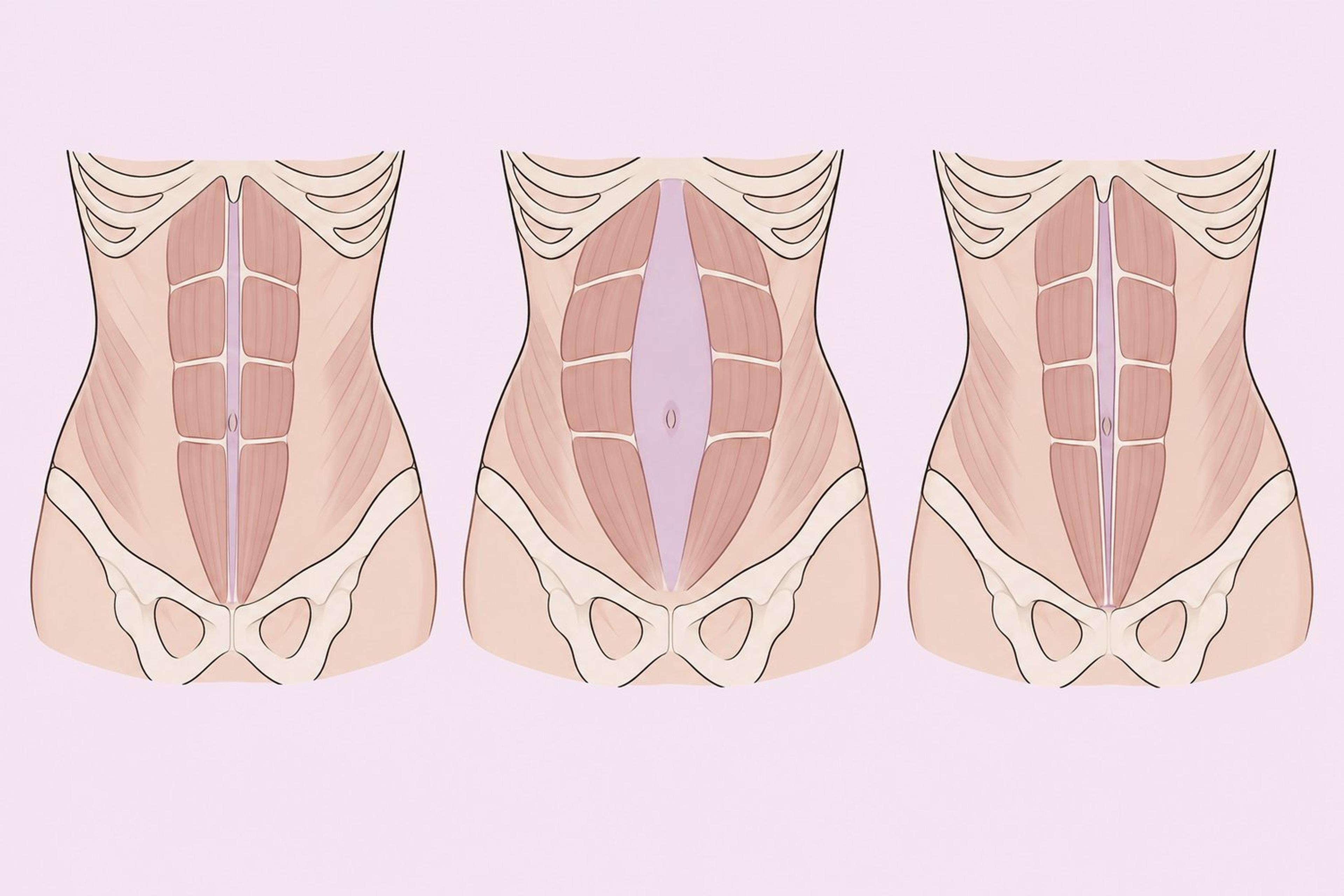 Medical diagram comparing aligned abdominal muscles with postpartum diastasis recti
