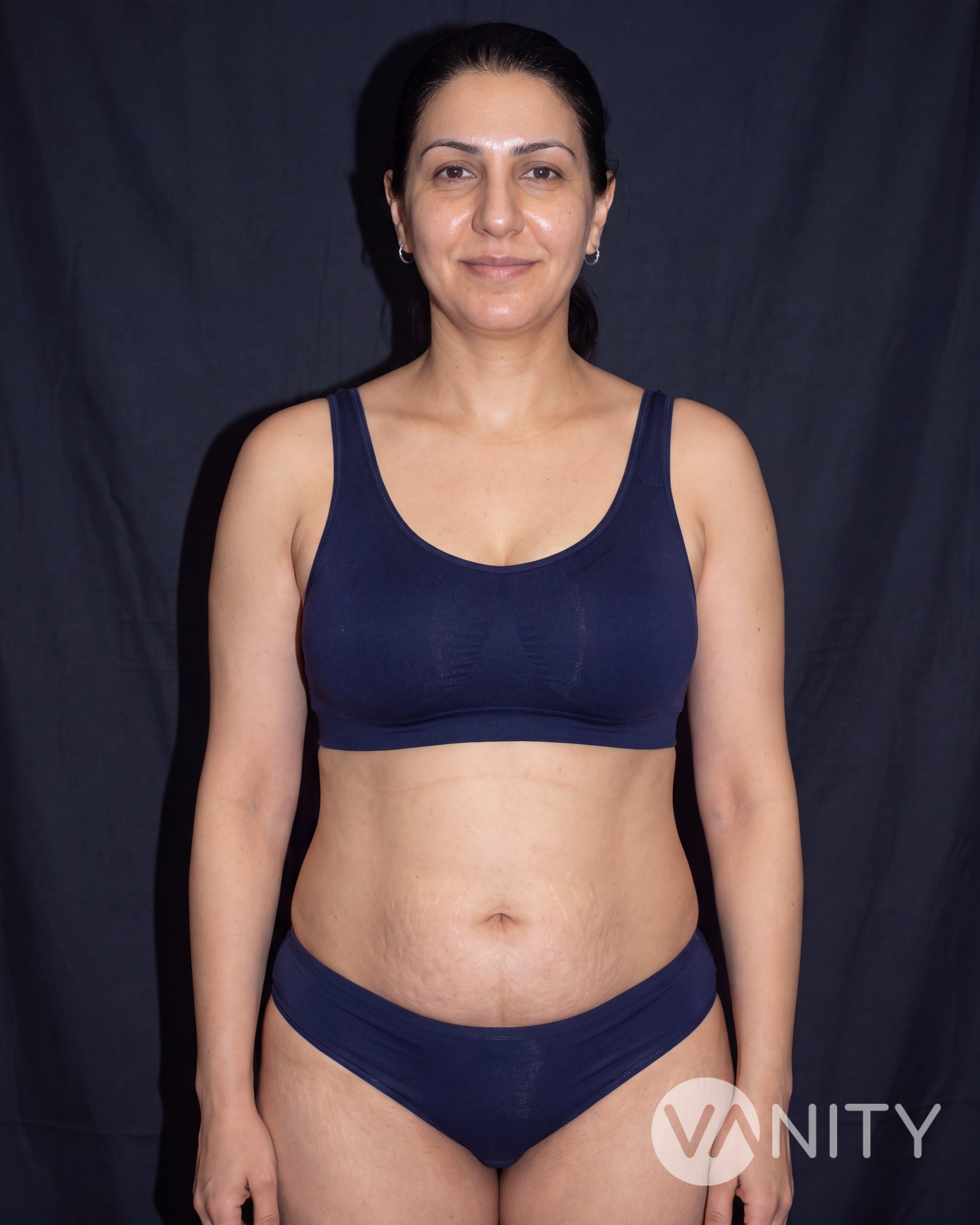 Mommy makeover