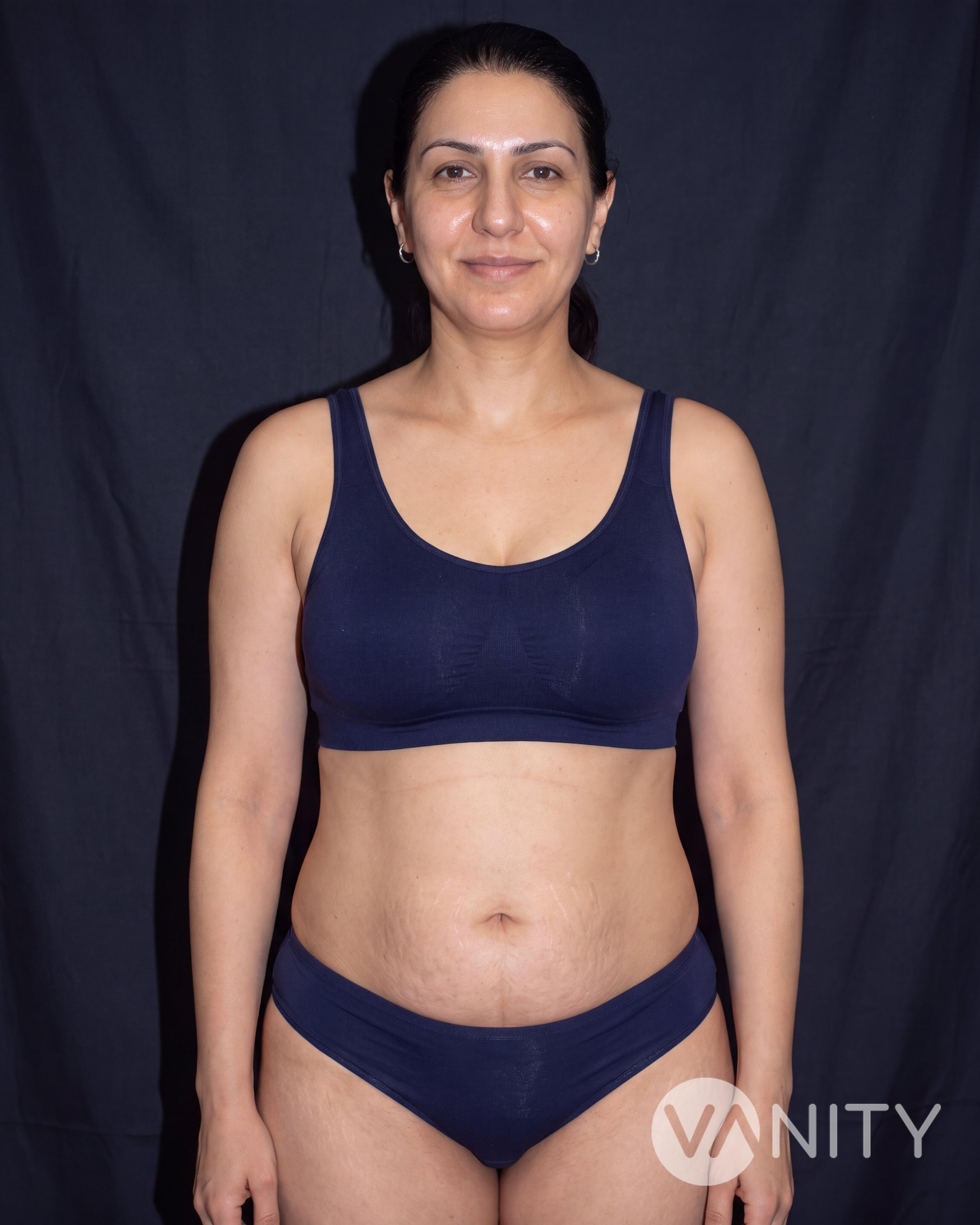 After Mommy makeover — illustrative, not a real patient