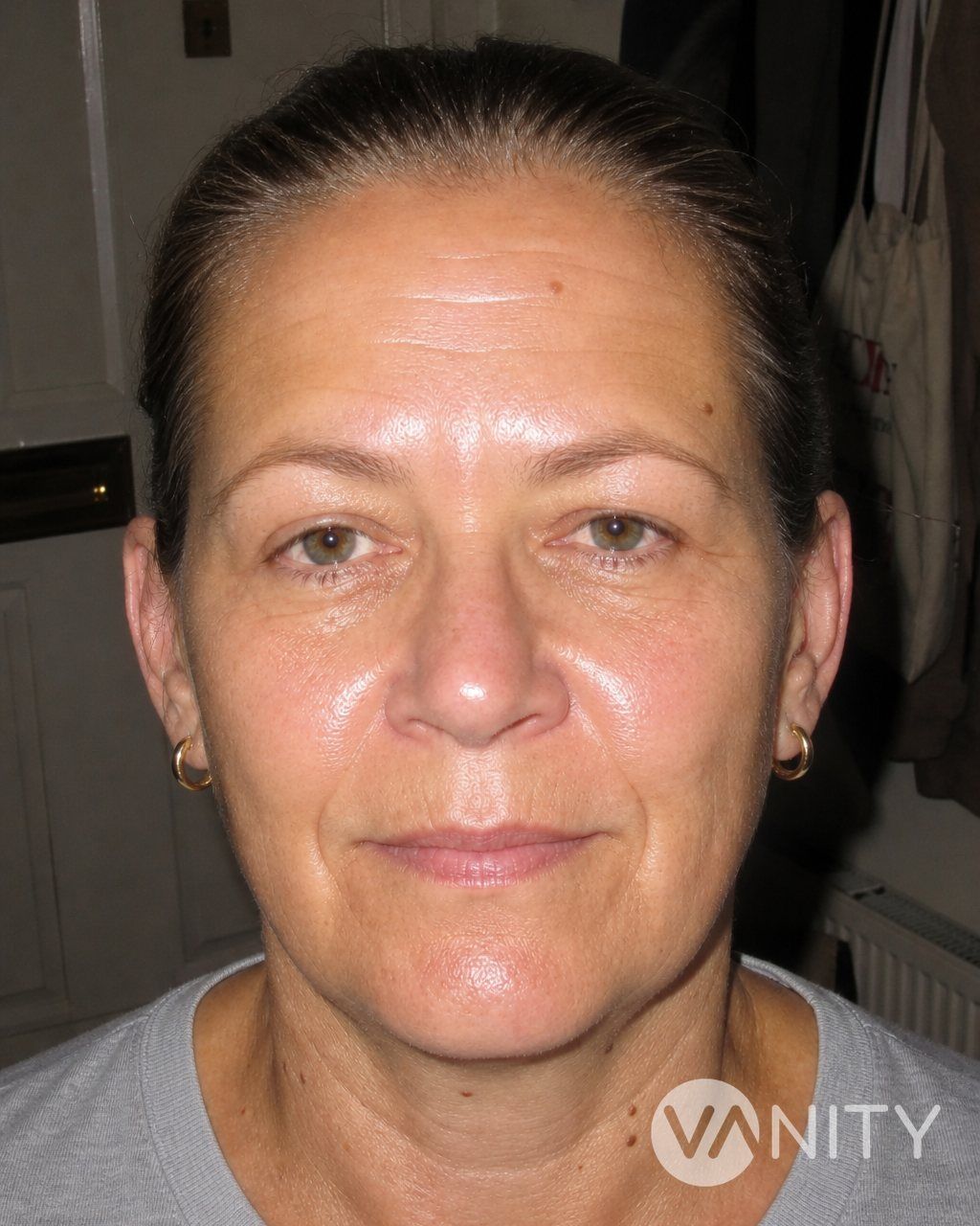 After Forehead lift — illustrative, not a real patient
