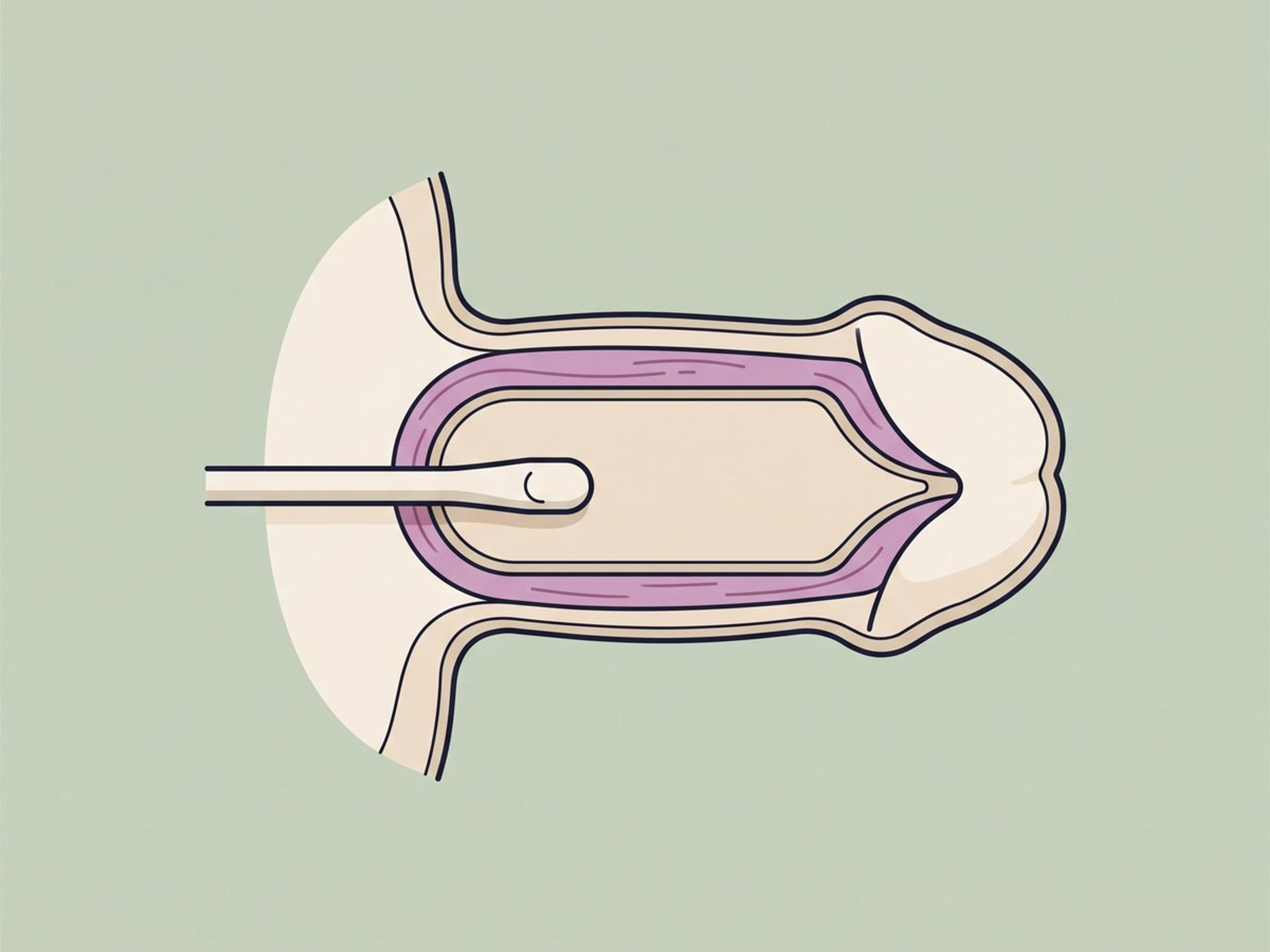 Innesto di grasso autologo sottodartos — illustration
