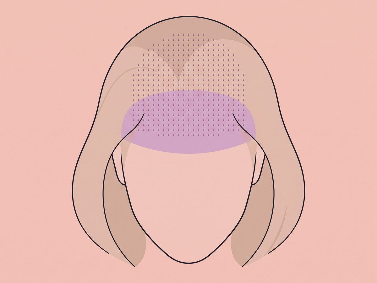 Scalp injection for pattern hair loss — illustration