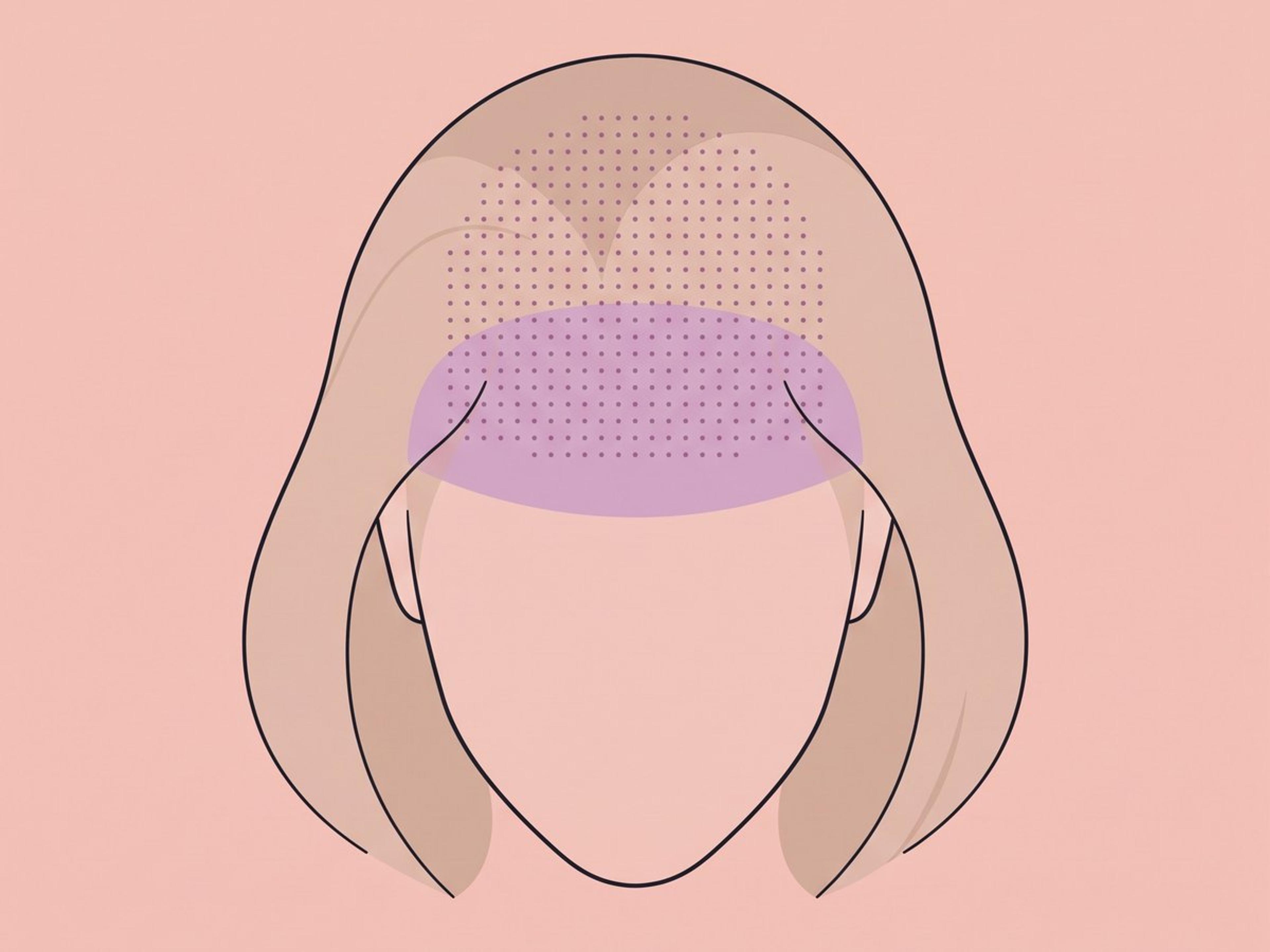 Scalp injection for pattern hair loss — illustration