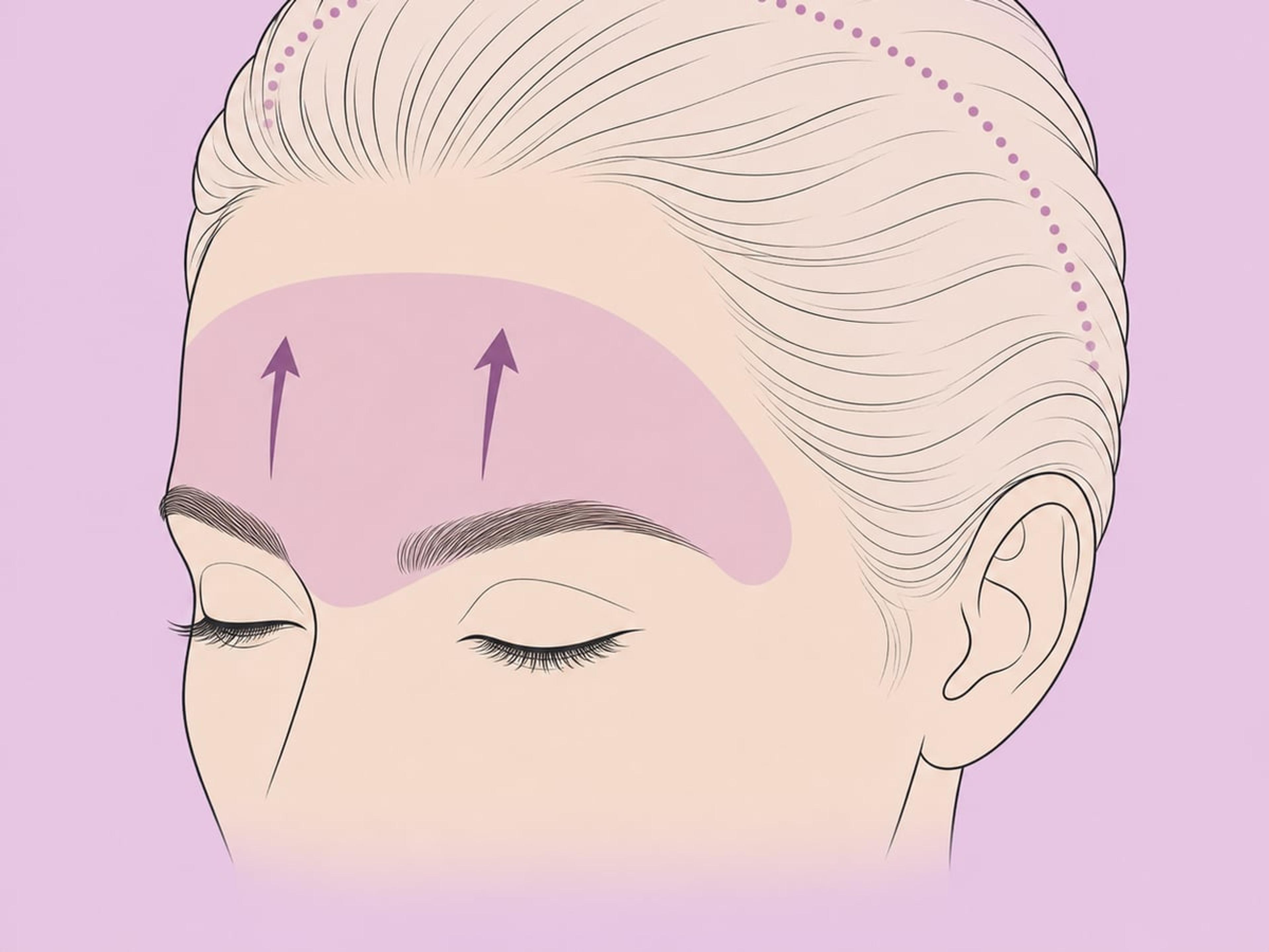Koronarer (offener) Stirnlift — illustration