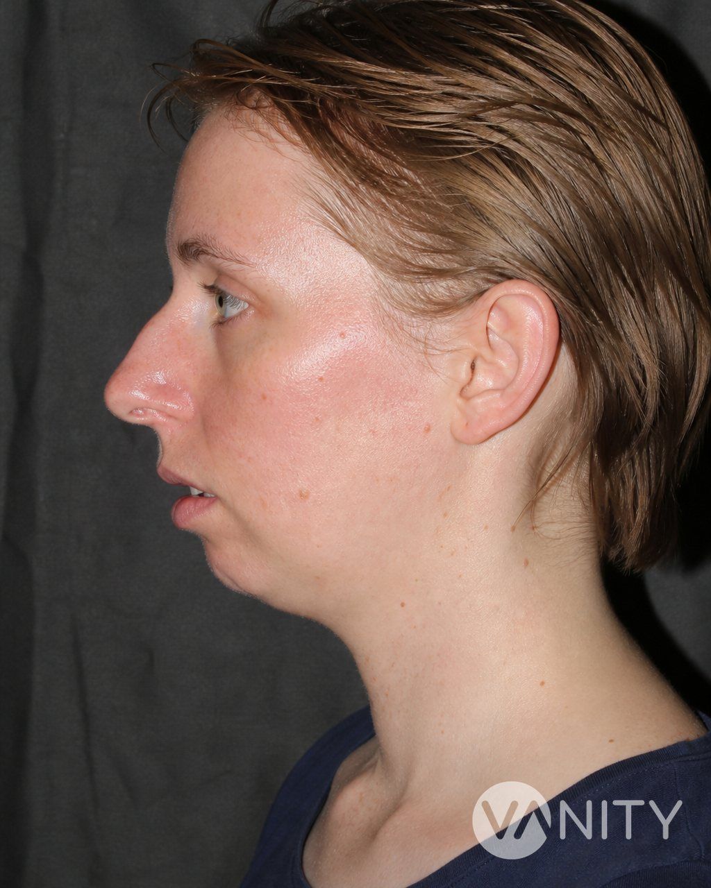 Before Chin augmentation — illustrative, not a real patient