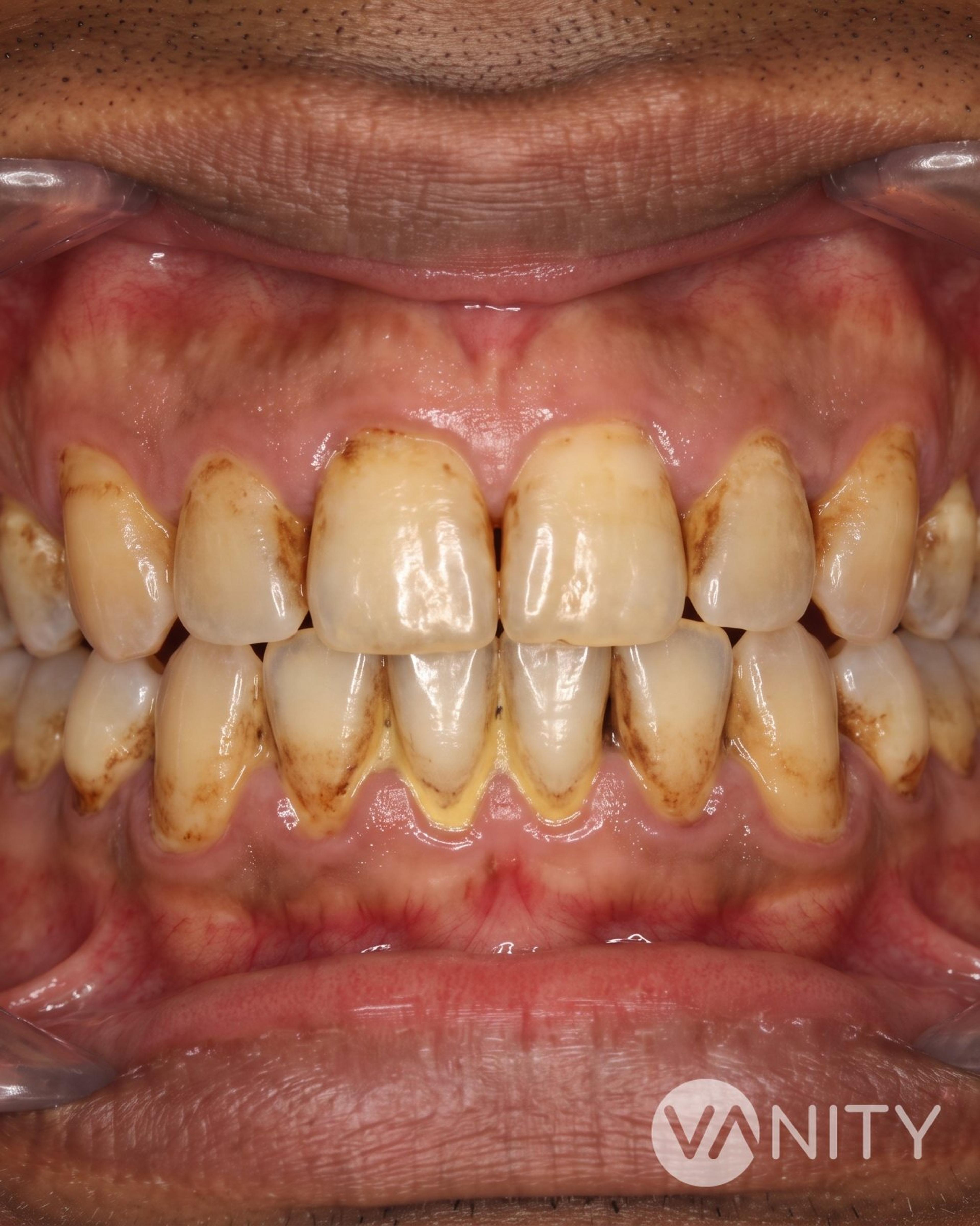 Before Teeth whitening — illustrative, not a real patient