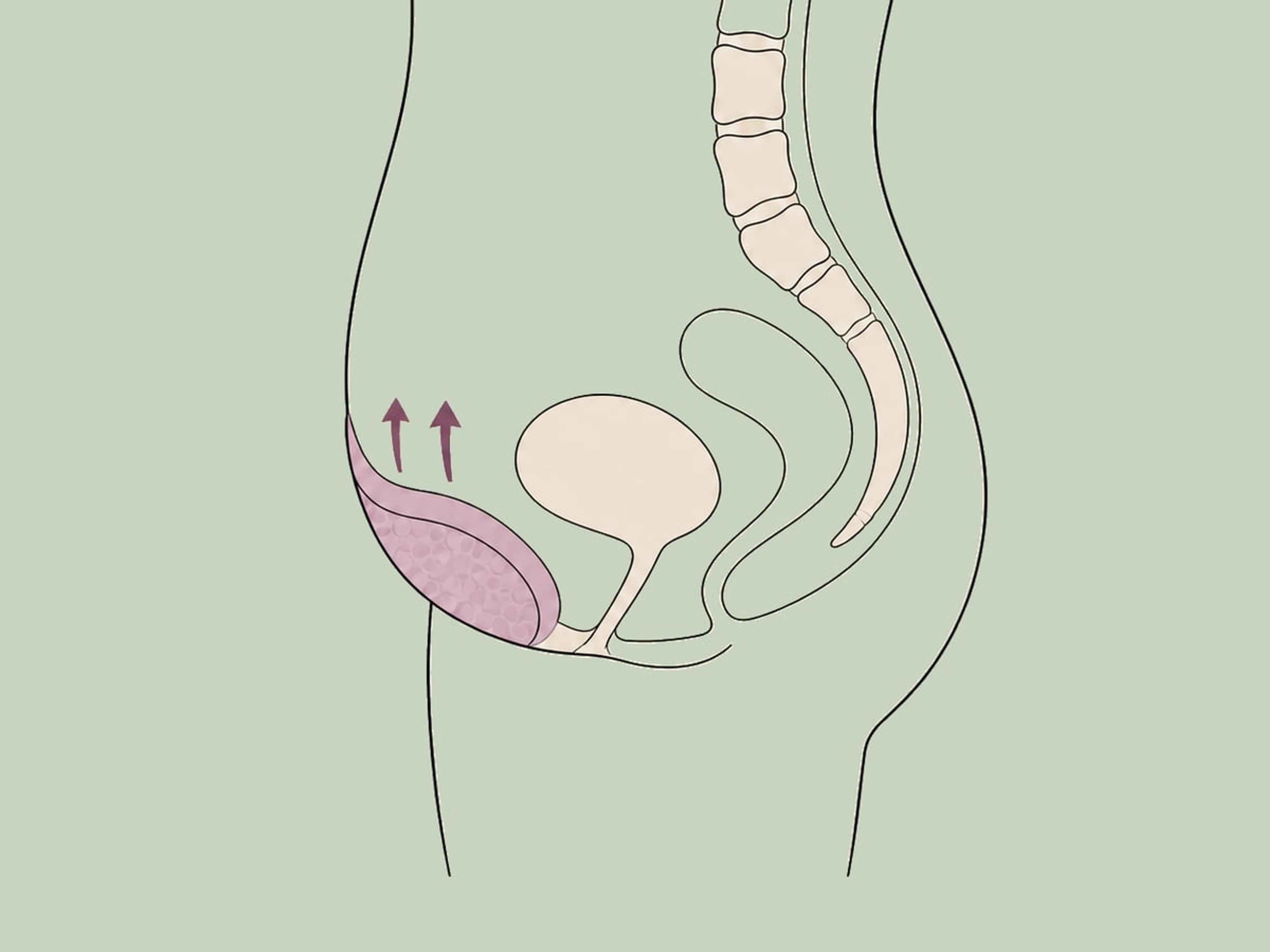 Monsplastik (Schamhügelstraffung) — illustration