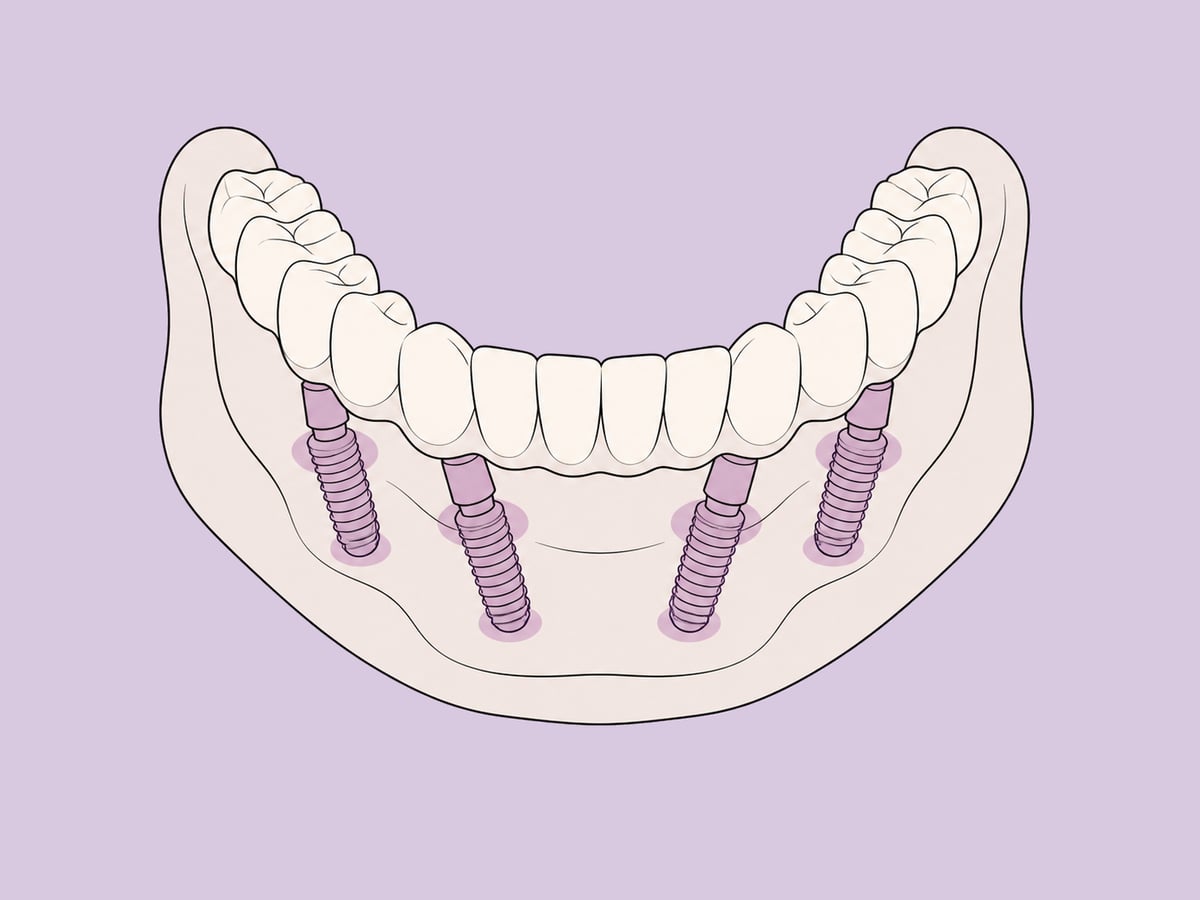تعويض ثابت لكامل القوس على أربع إلى ست زرعات — illustration