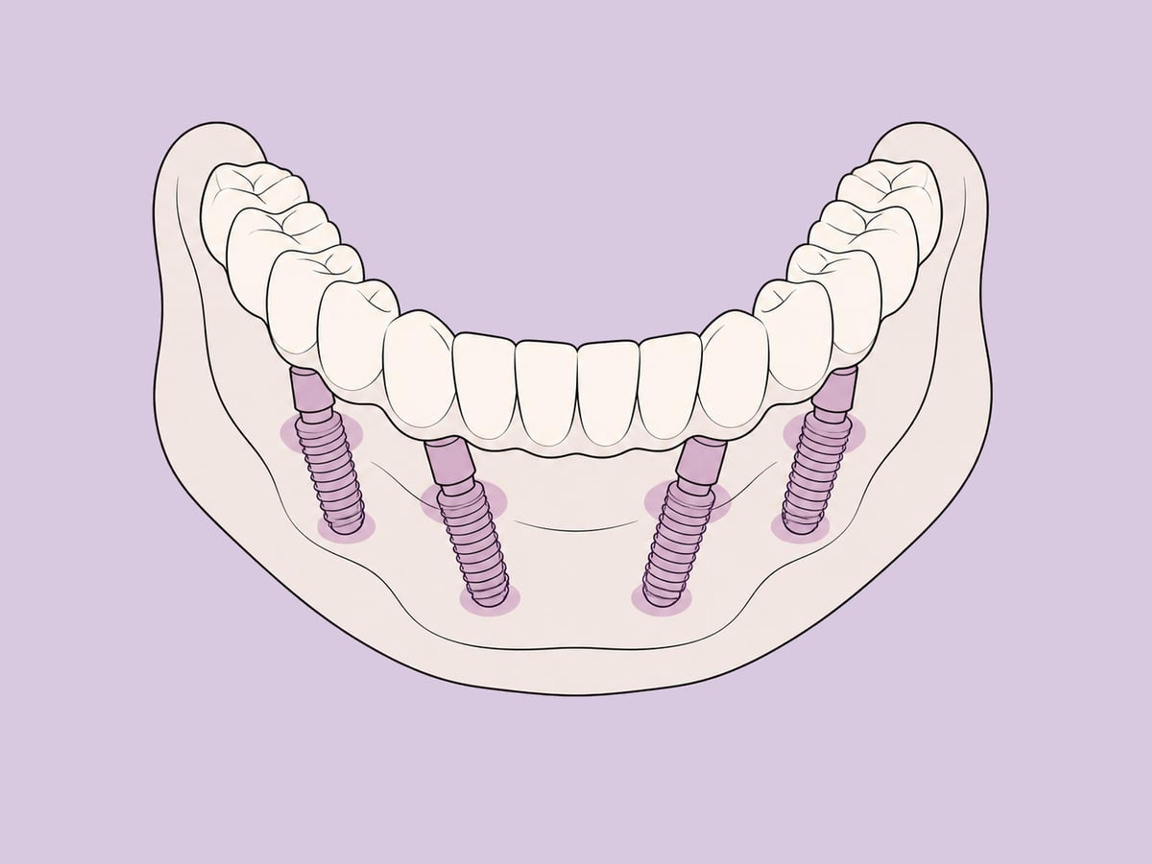 تعويض ثابت لكامل القوس على أربع إلى ست زرعات — illustration