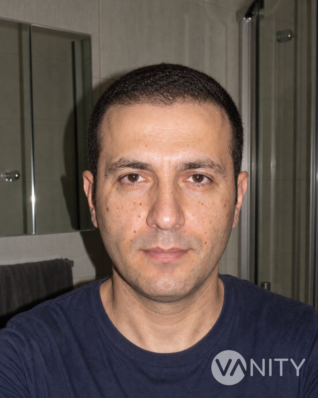 Haartransplantation