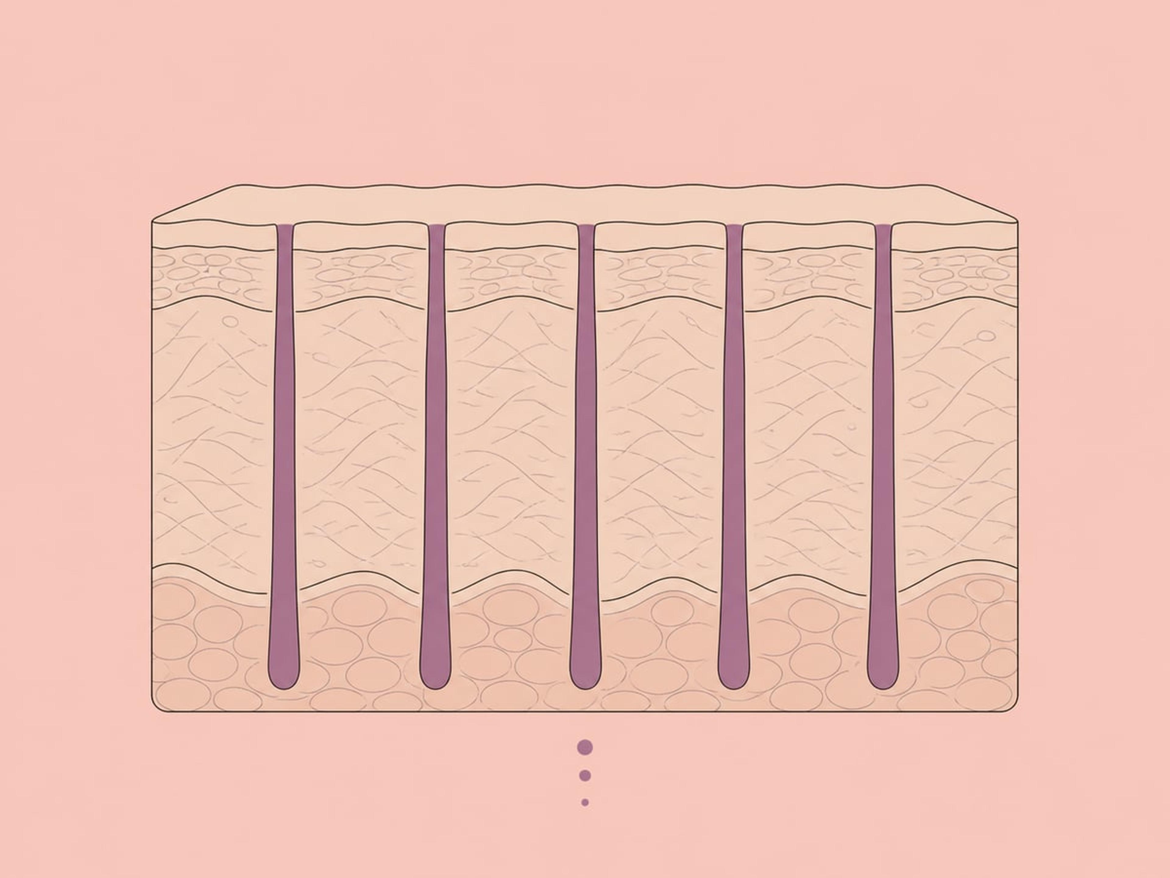 Fraktionierter ablativer CO2-Laser (10.600 nm) — illustration