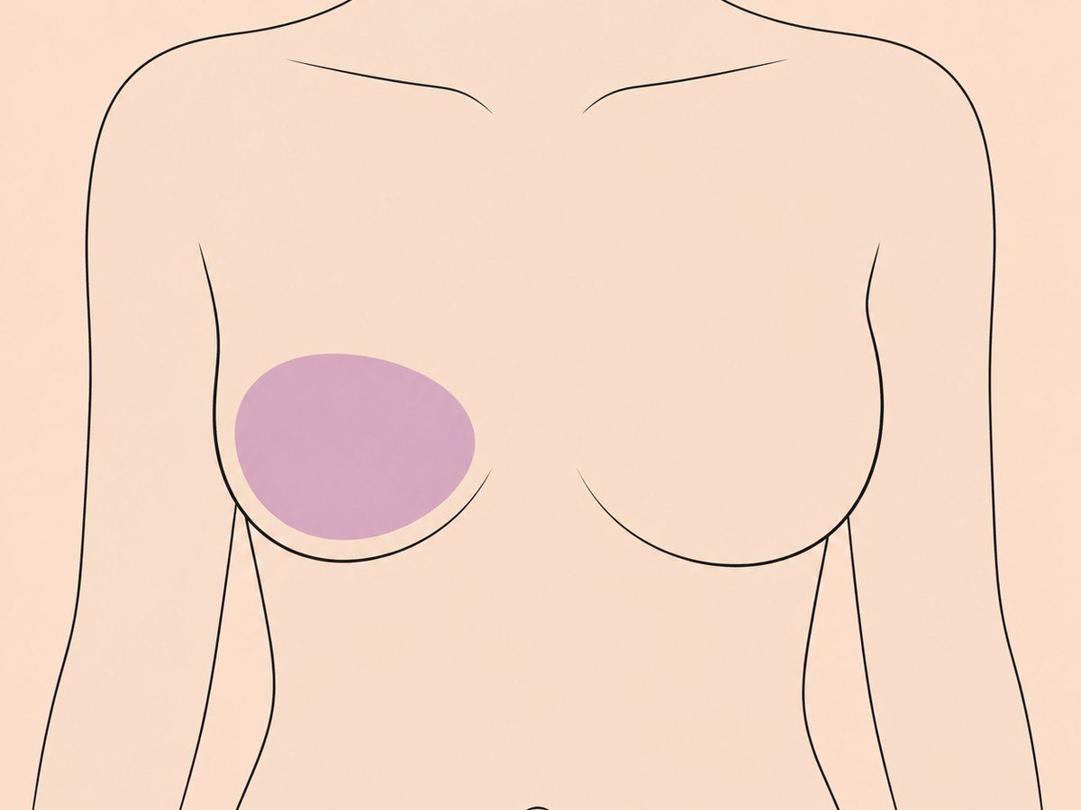Korrektur ungleichmäßiger oder tubulärer Brüste — illustration