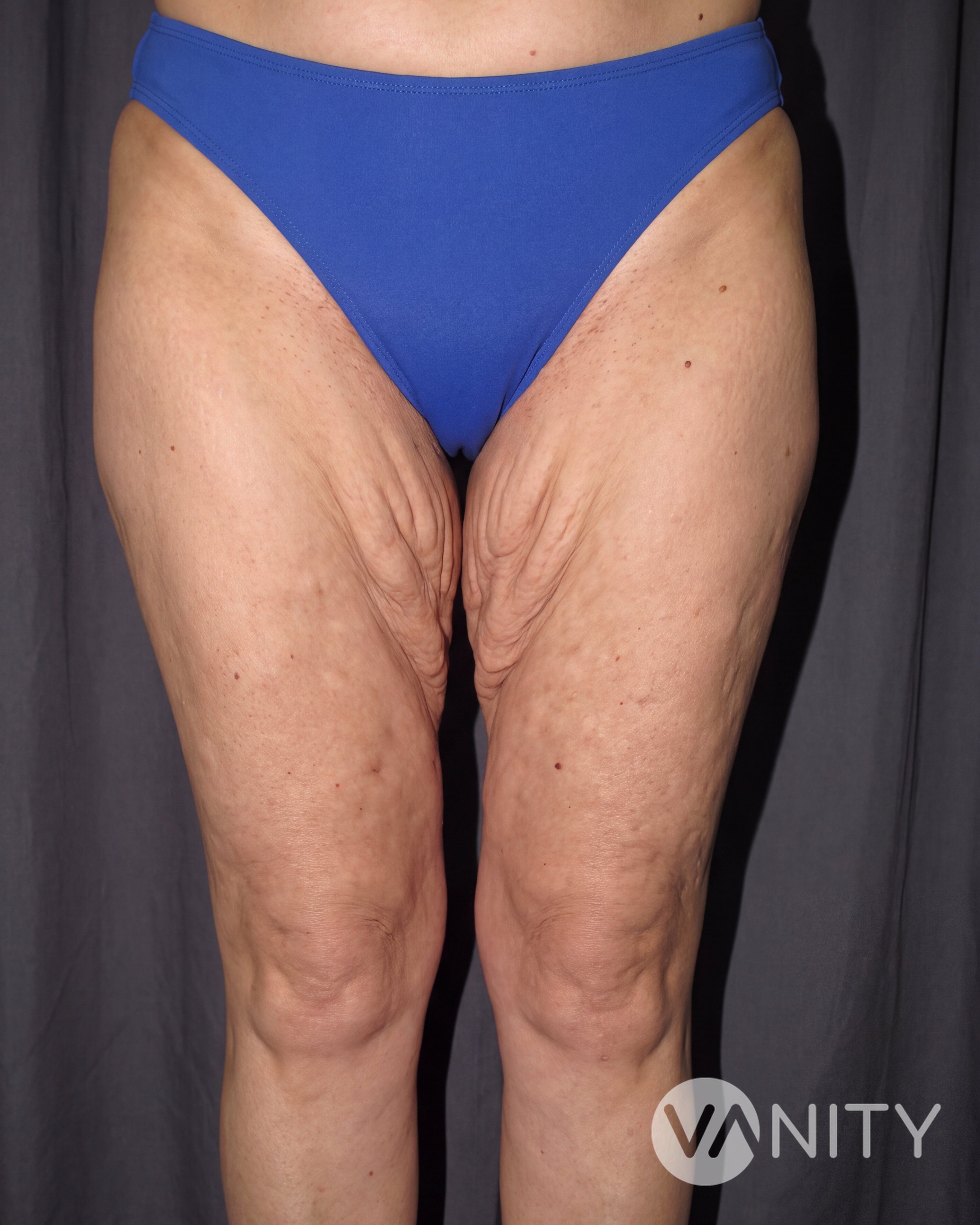 Before Thigh lift — illustrative, not a real patient