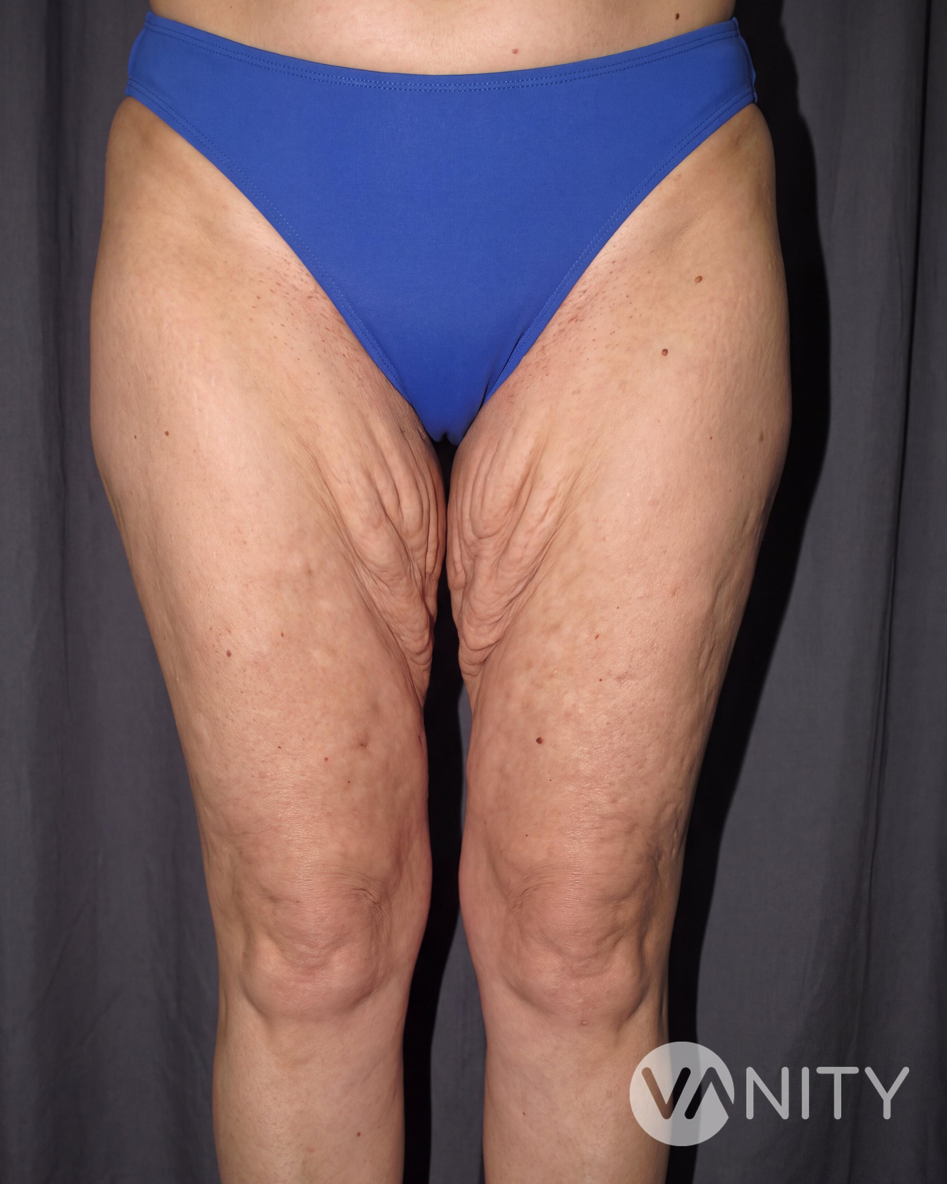 Before Thigh lift — illustrative, not a real patient
