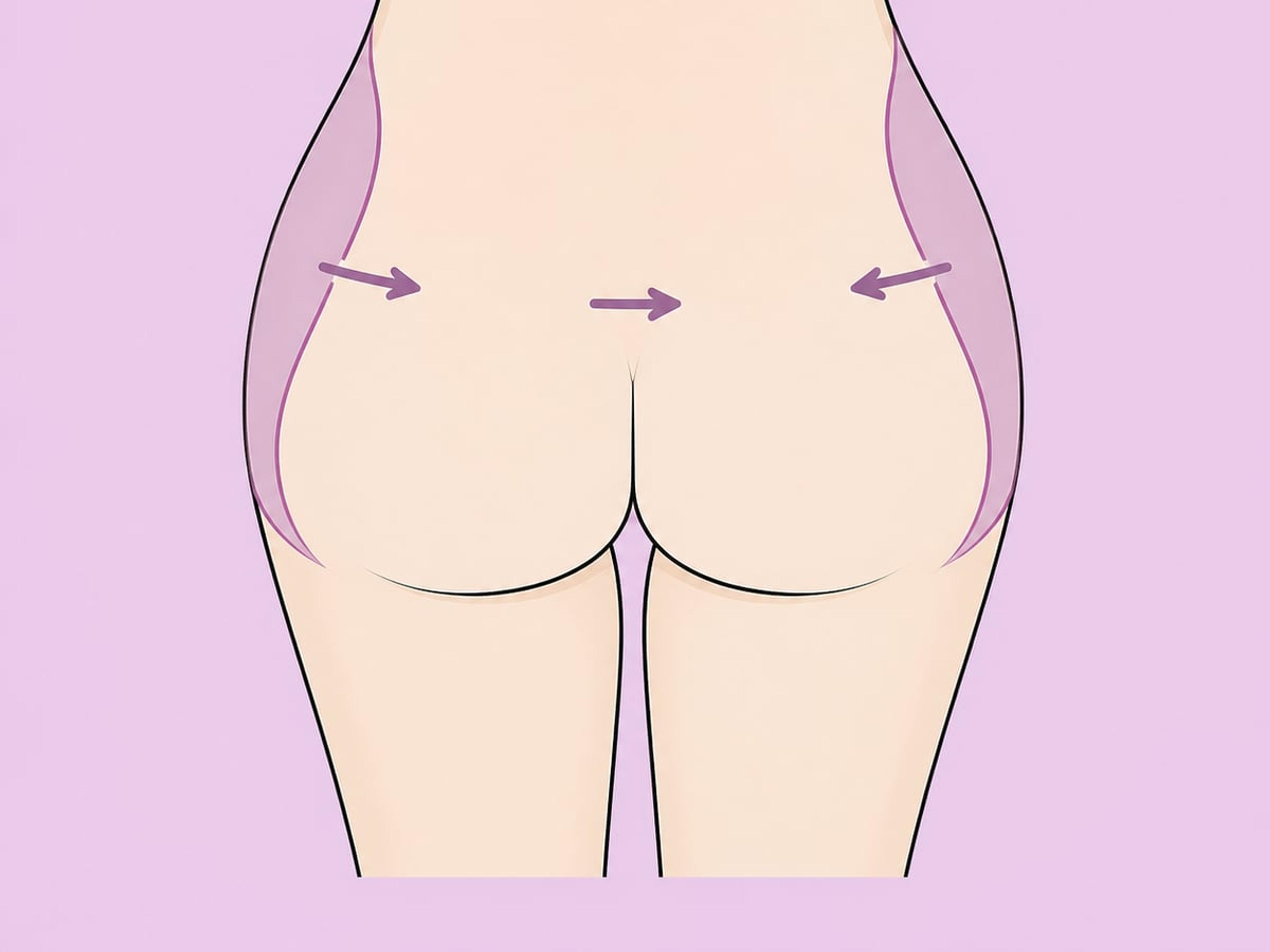 Brazilian Butt Lift (BBL) — gluteale Fetttransplantation — illustration