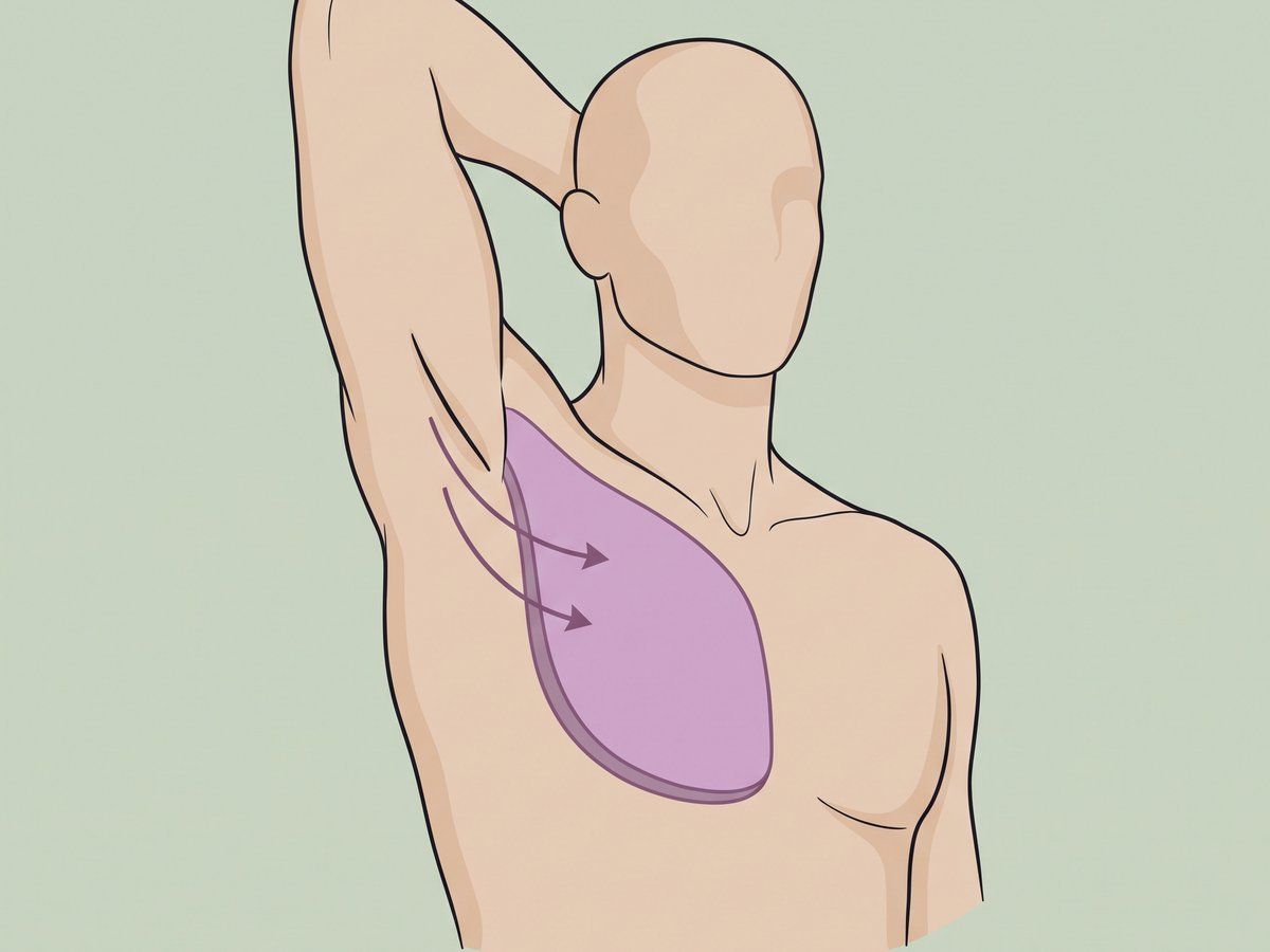 Transaxilläre submuskuläre Platzierung — illustration