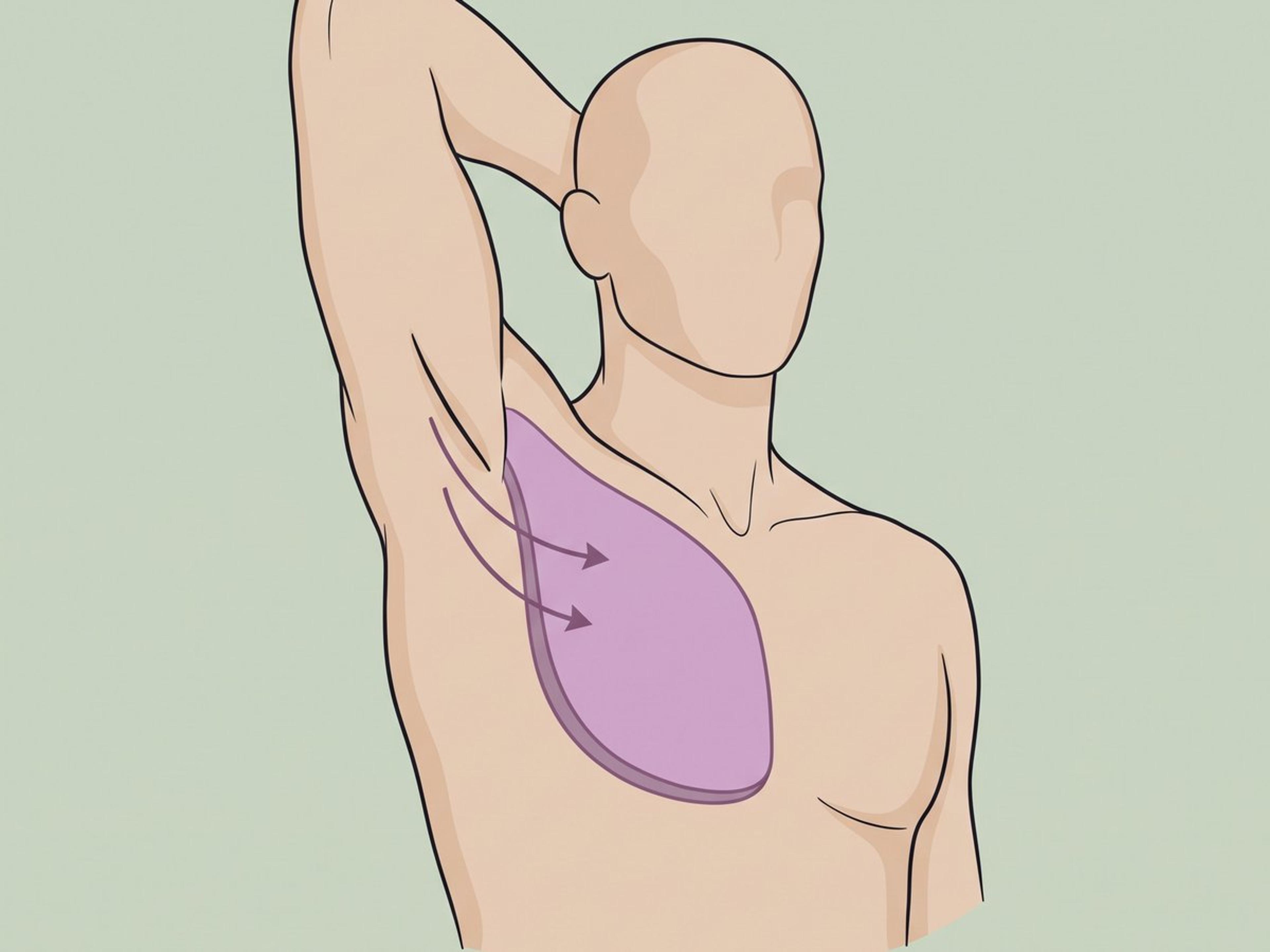 Transaxilläre submuskuläre Platzierung — illustration