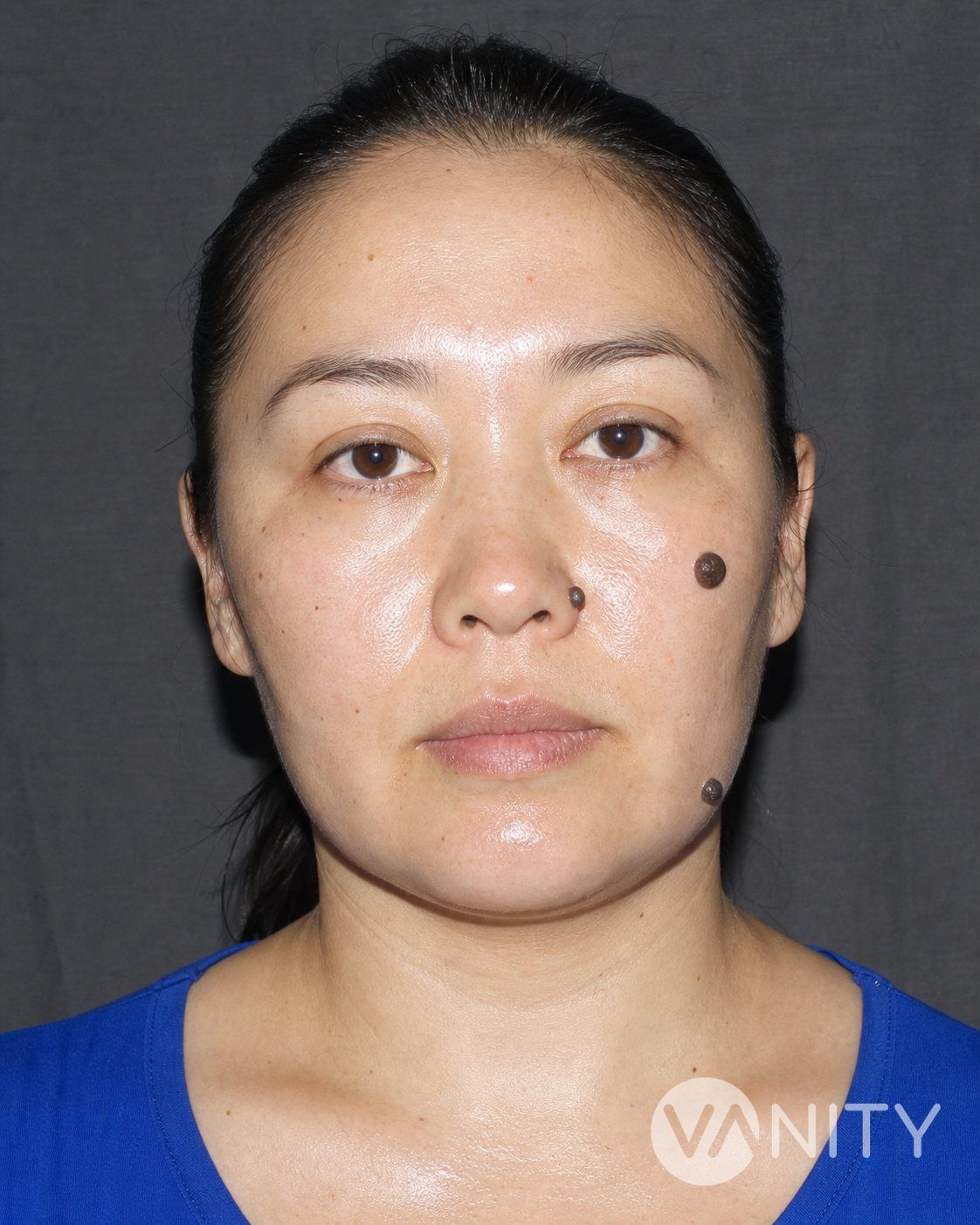 Before Mole removal — illustrative, not a real patient