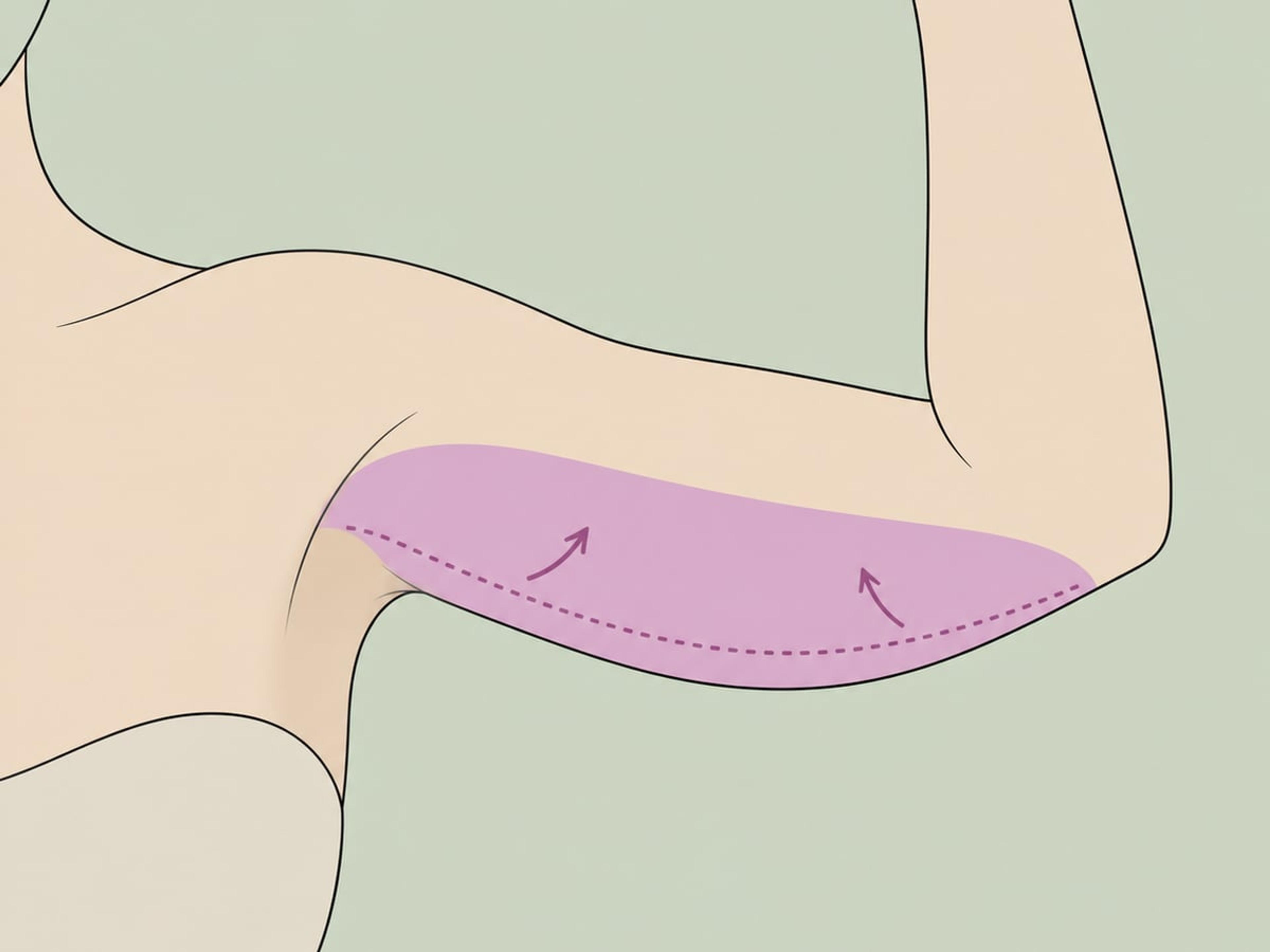Fettabsaugungsassistierte Oberarmstraffung — illustration