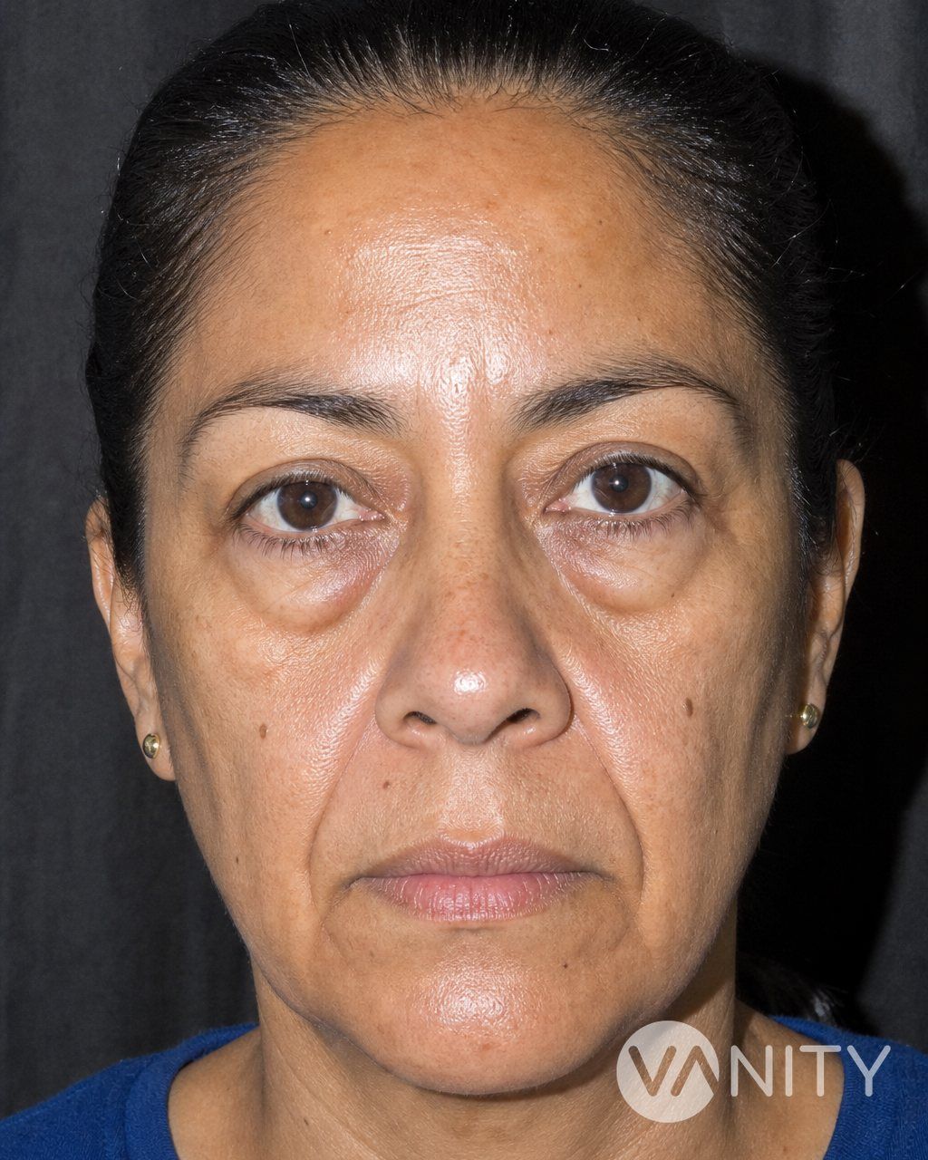 Before Mid-face lift — illustrative, not a real patient
