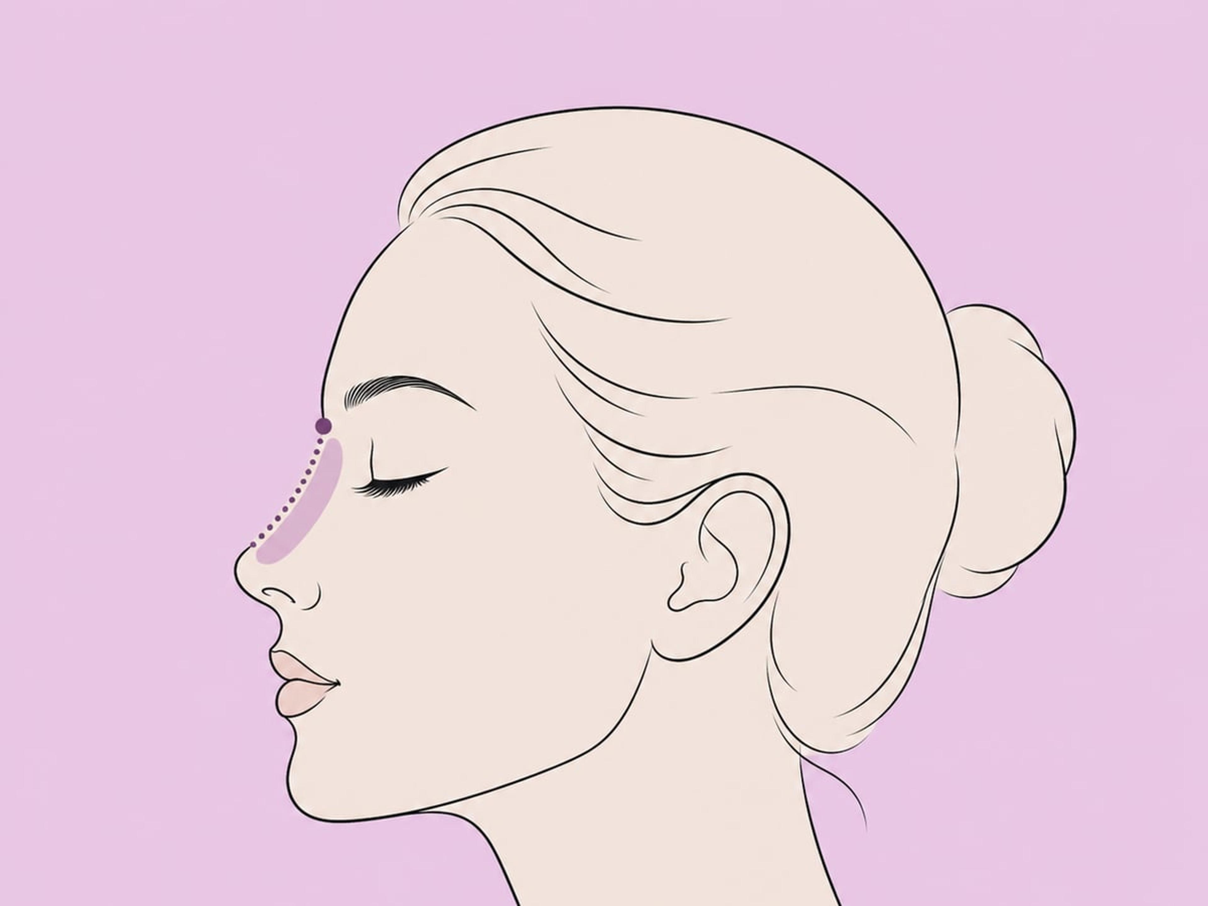 Kanülentechnik — illustration