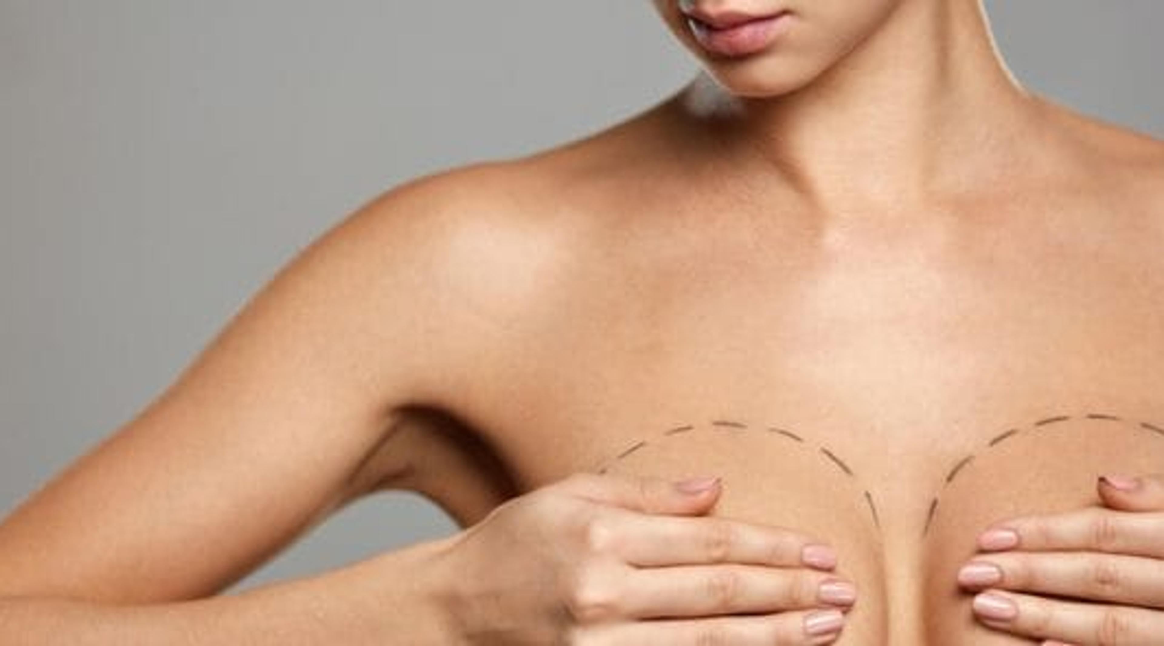 10 Myths About Breast Implants